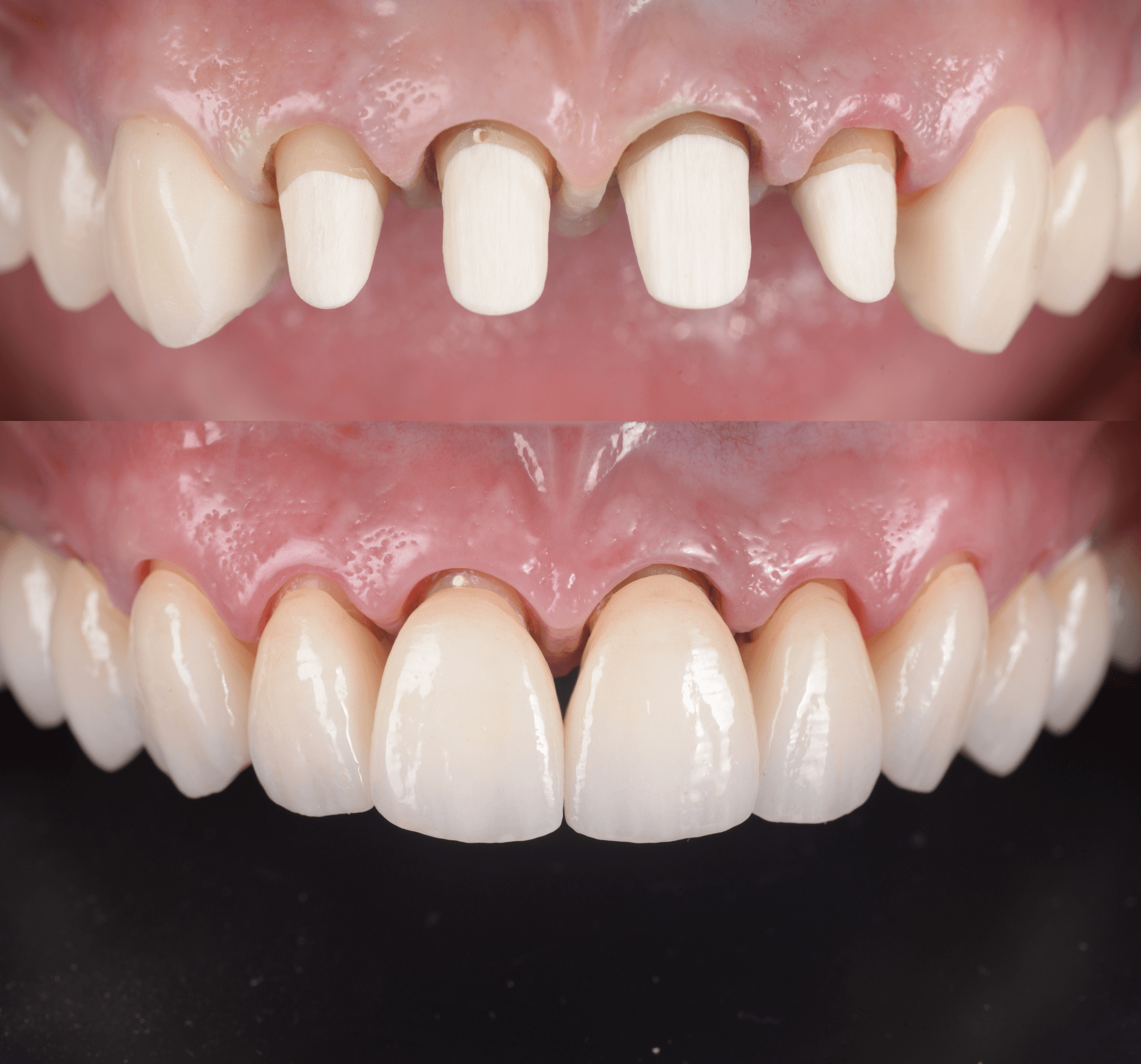 endo_
