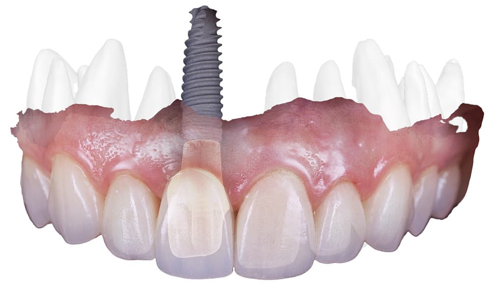 implantx