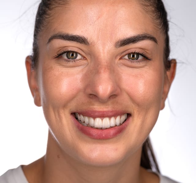 Final smile showing balance, improved gingival symmetry, and integration of new ceramic restorations.  Imag