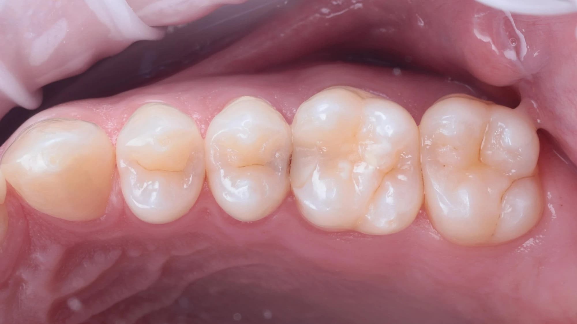 Back teeth before treatment, with a dark shadow between two teeth