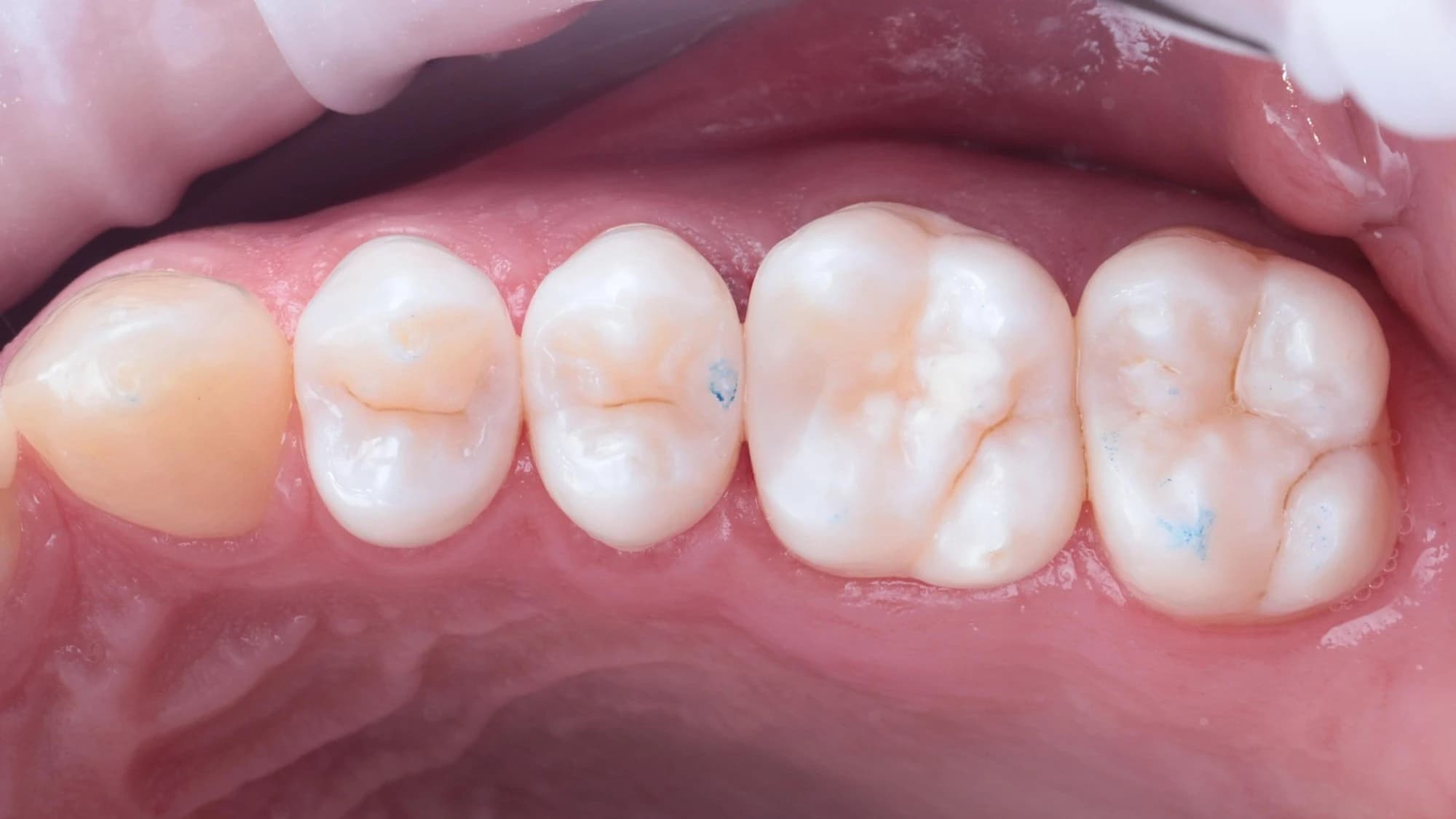 The finished fillings after the rubber dam was removed, with bite marks