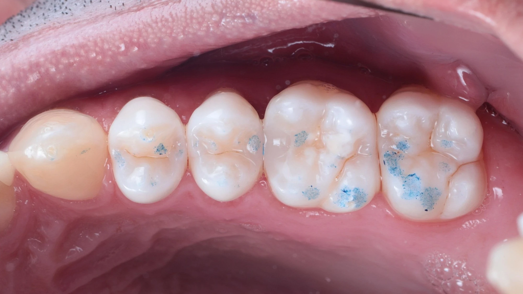 Bite marks spread evenly across the restored teeth