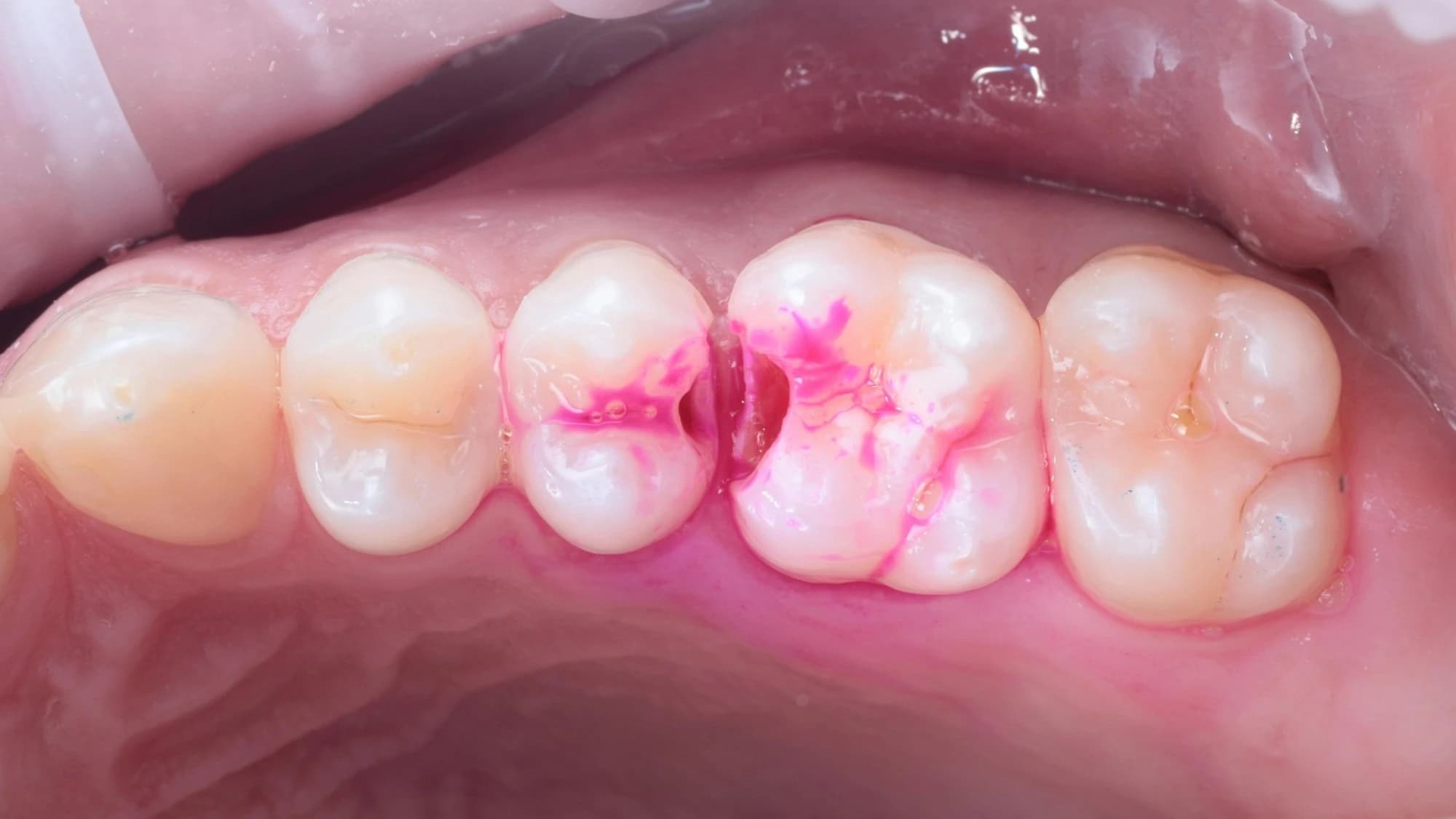 A dye marking the decayed tissue inside the cavity