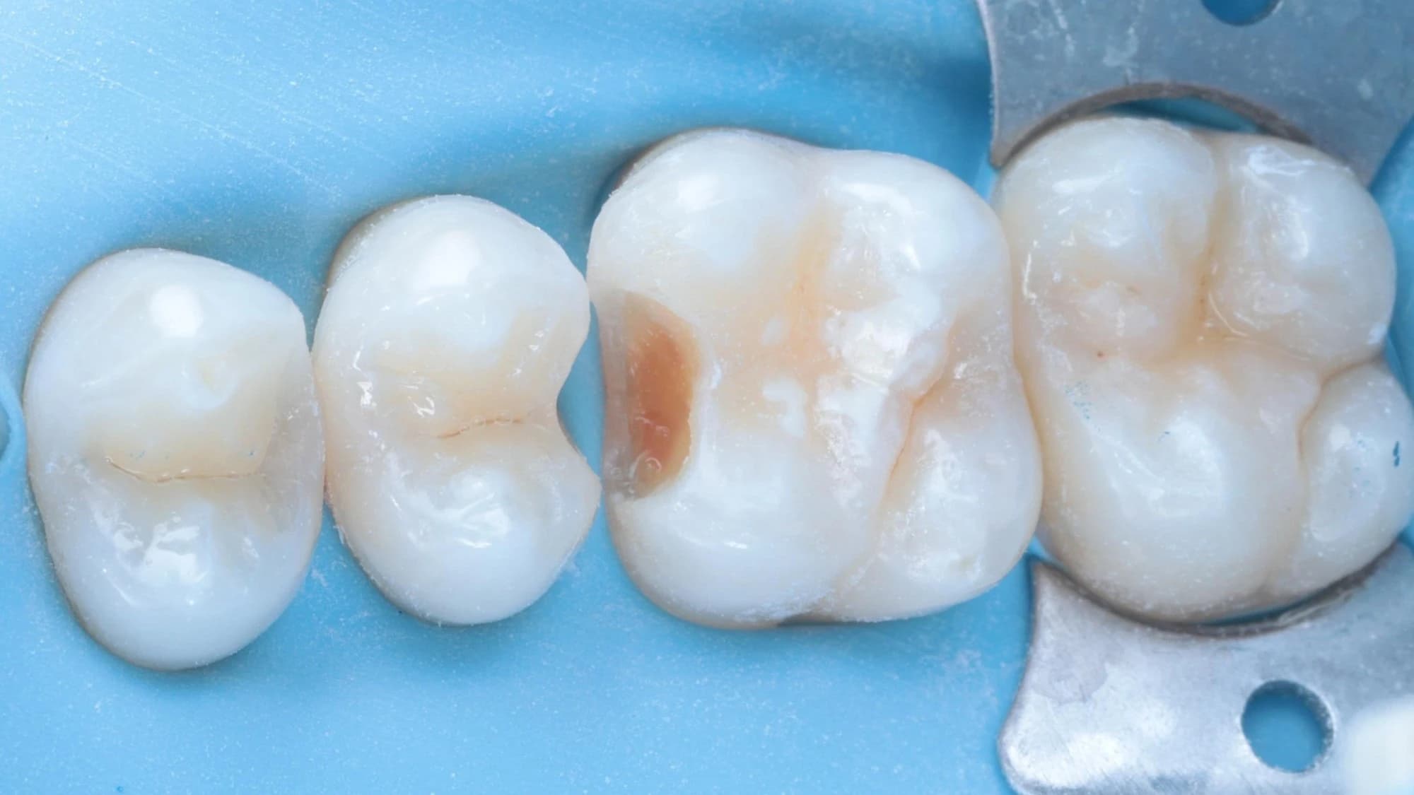 The teeth isolated with a rubber dam