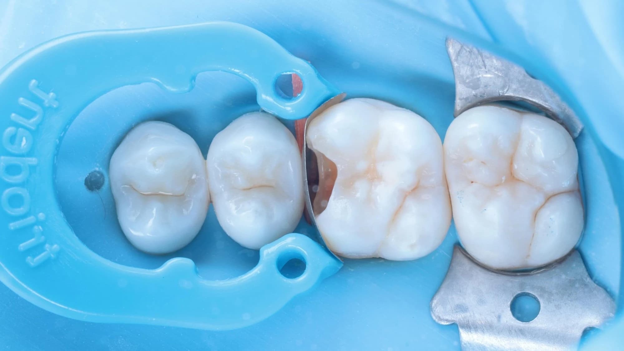 A thin matrix and ring around the tooth to shape the missing wall