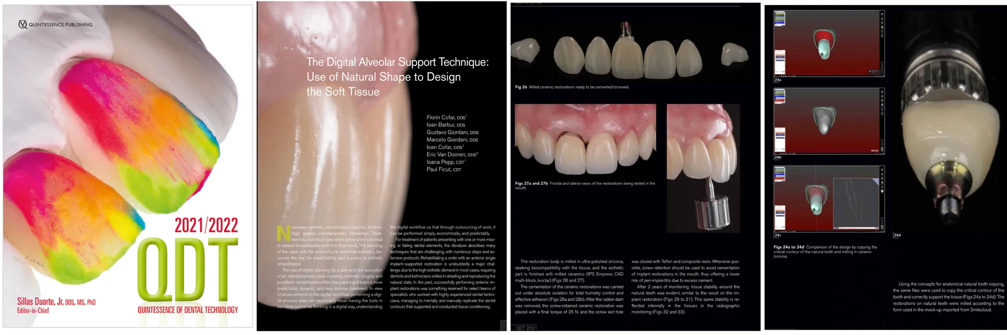 Digital Alveolar Support Technique: Use of Natural Shape to Design the Soft Tissue