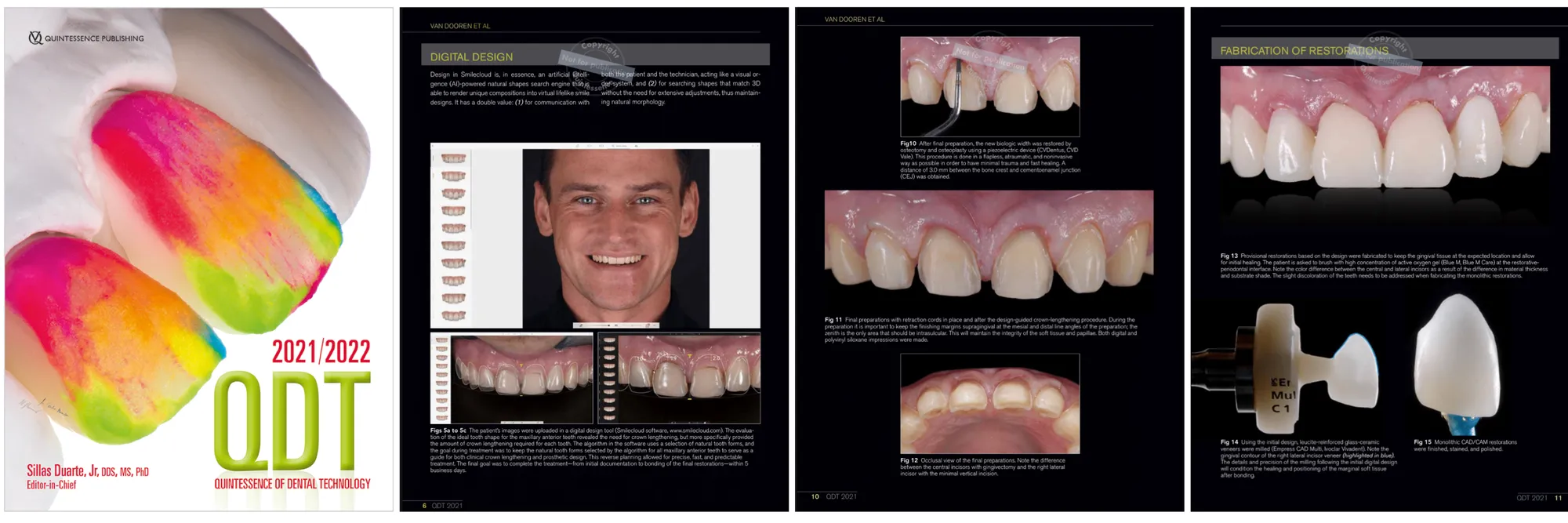 Healing Guided by Design: The Crown-Lengthening Procedure Revisited