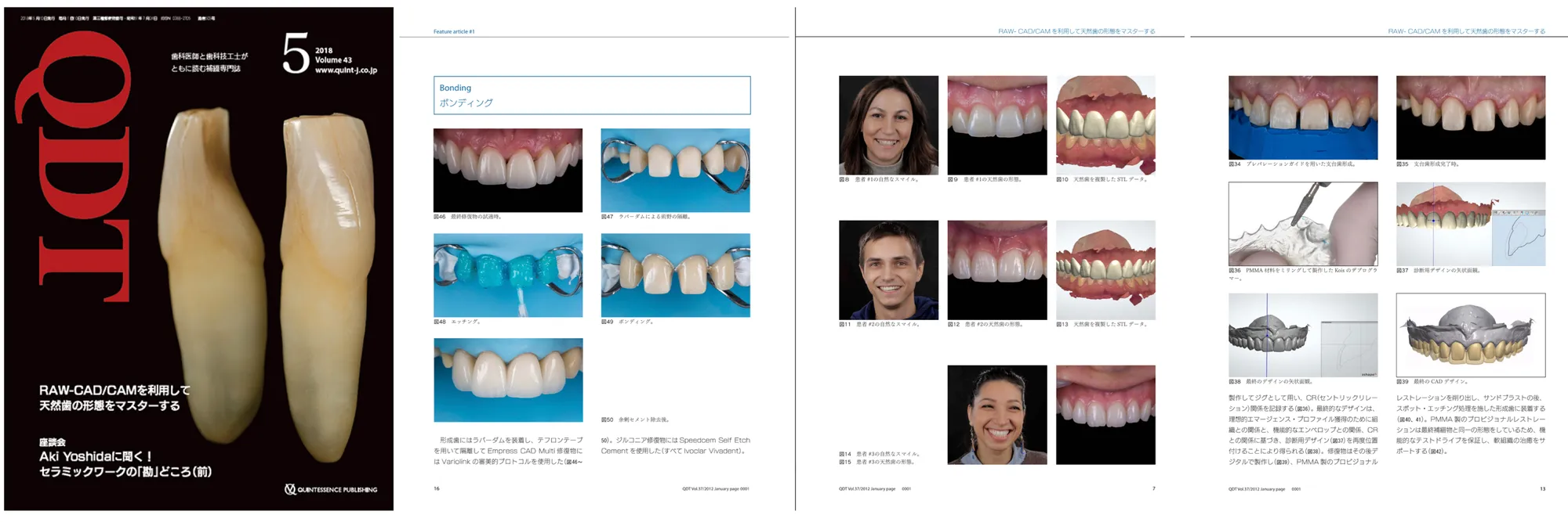 RAW: Mastering Natural Tooth Morphology Using CAD/CAM