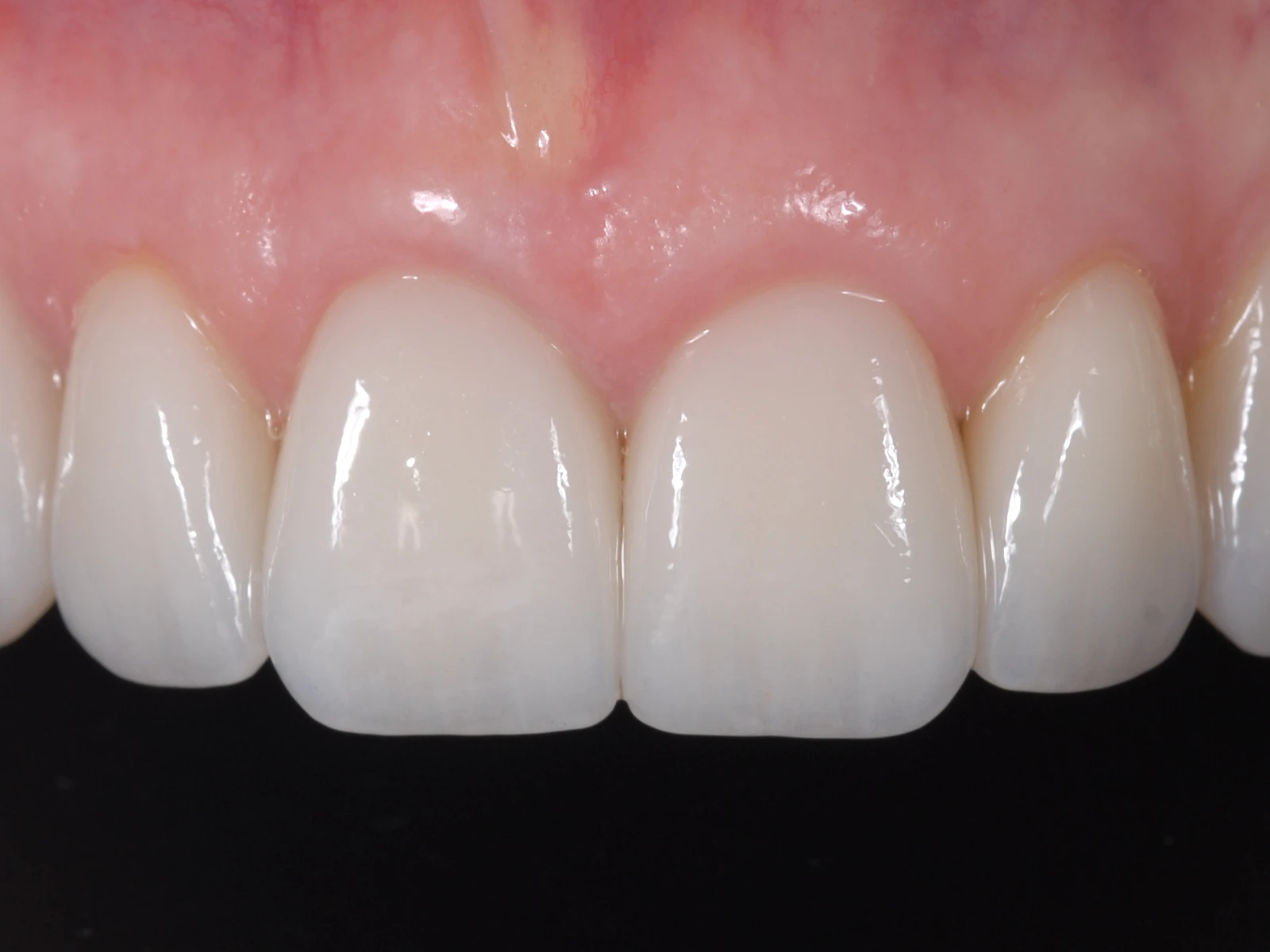 The healed gums around the new teeth