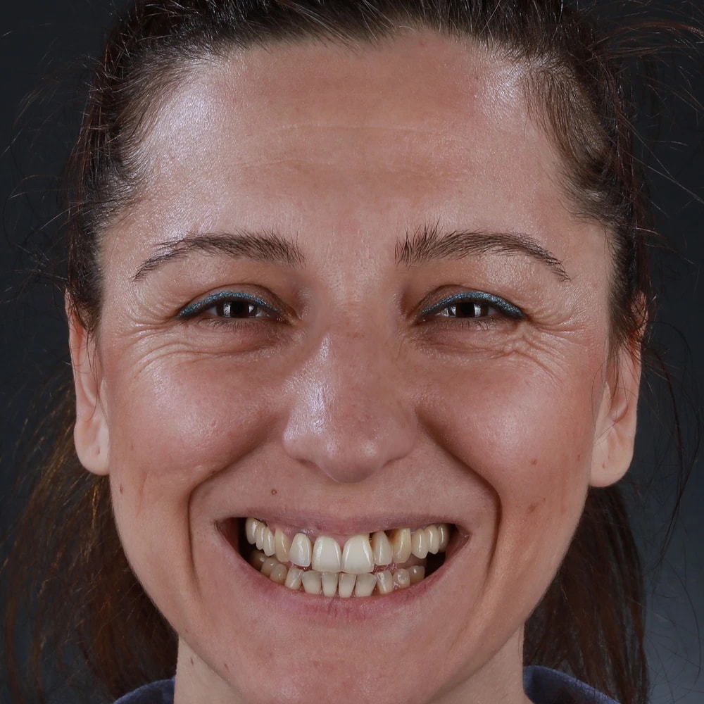The patient smiling before treatment