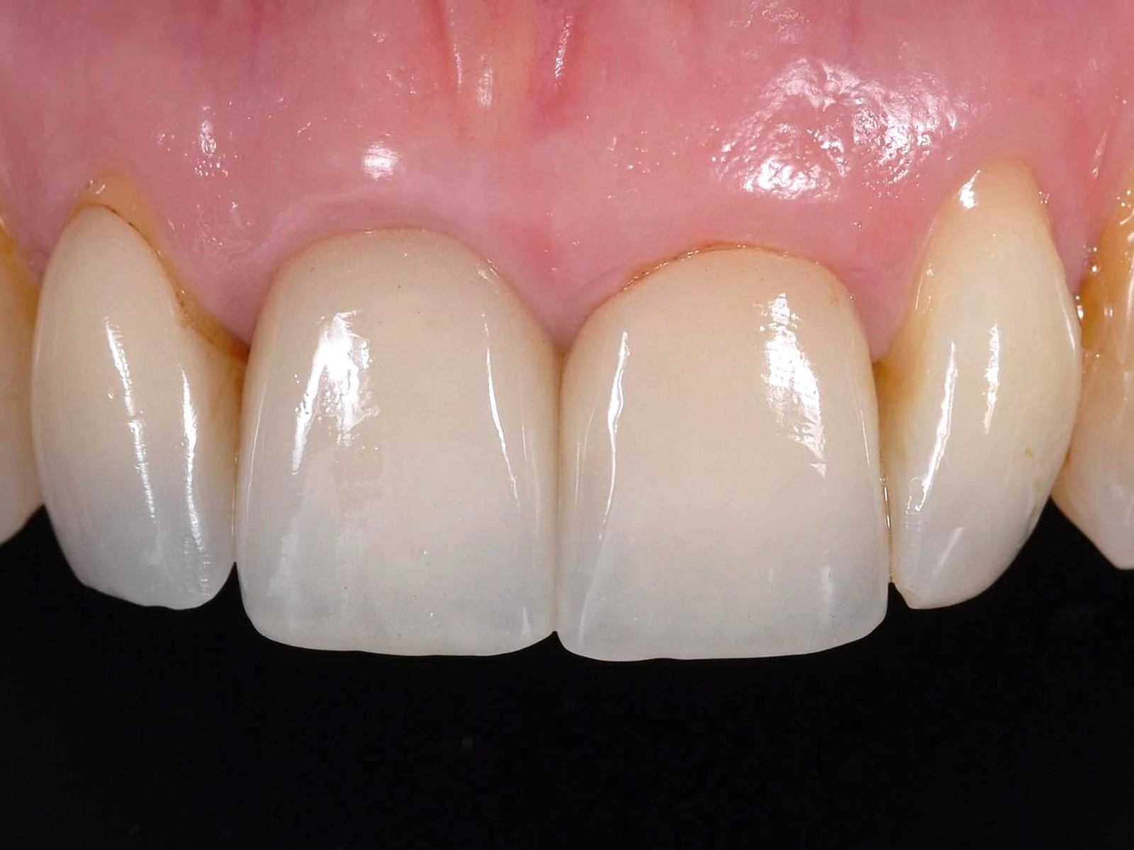 The gums and teeth before treatment