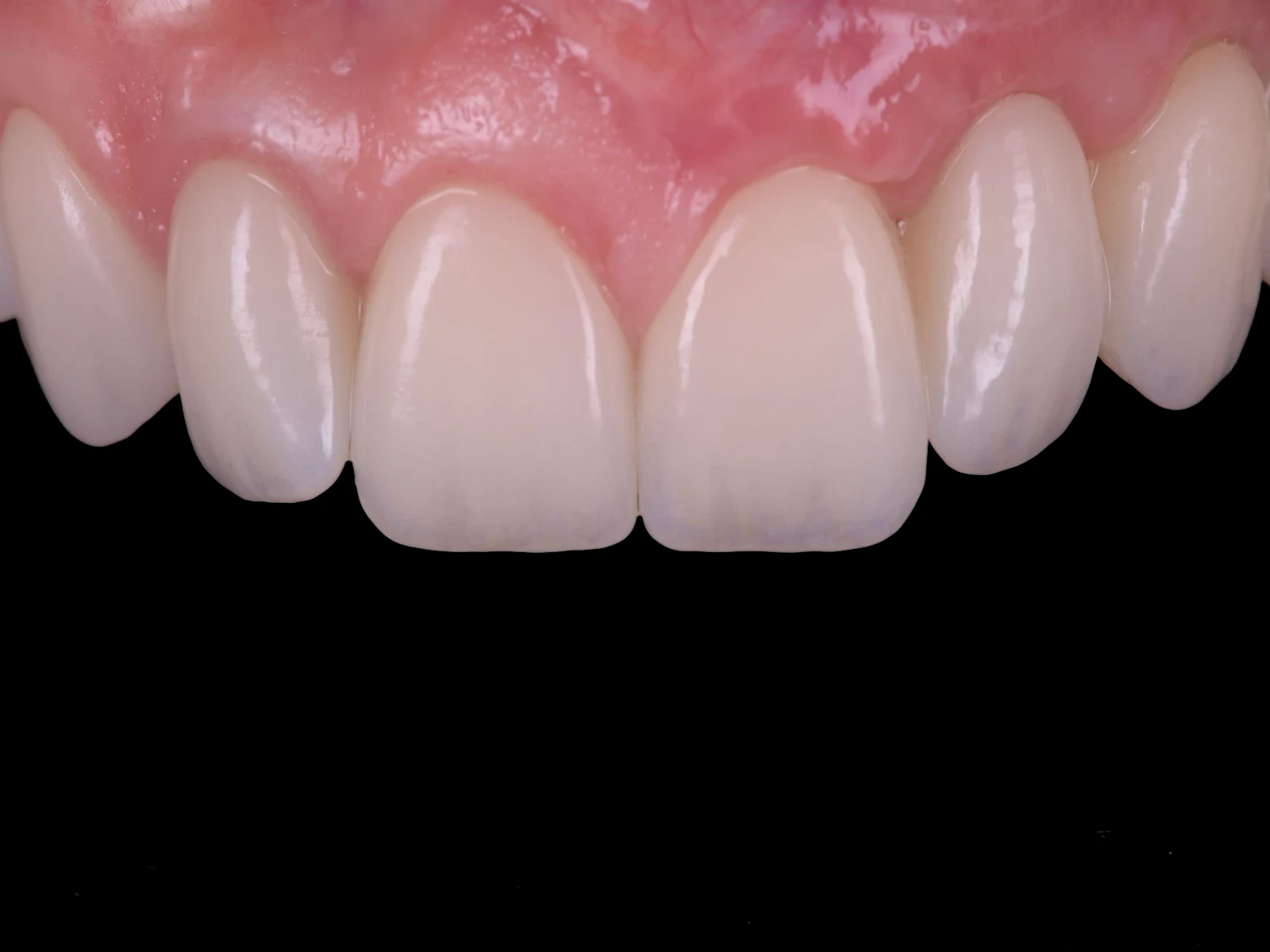 The same gums after grafting and new teeth