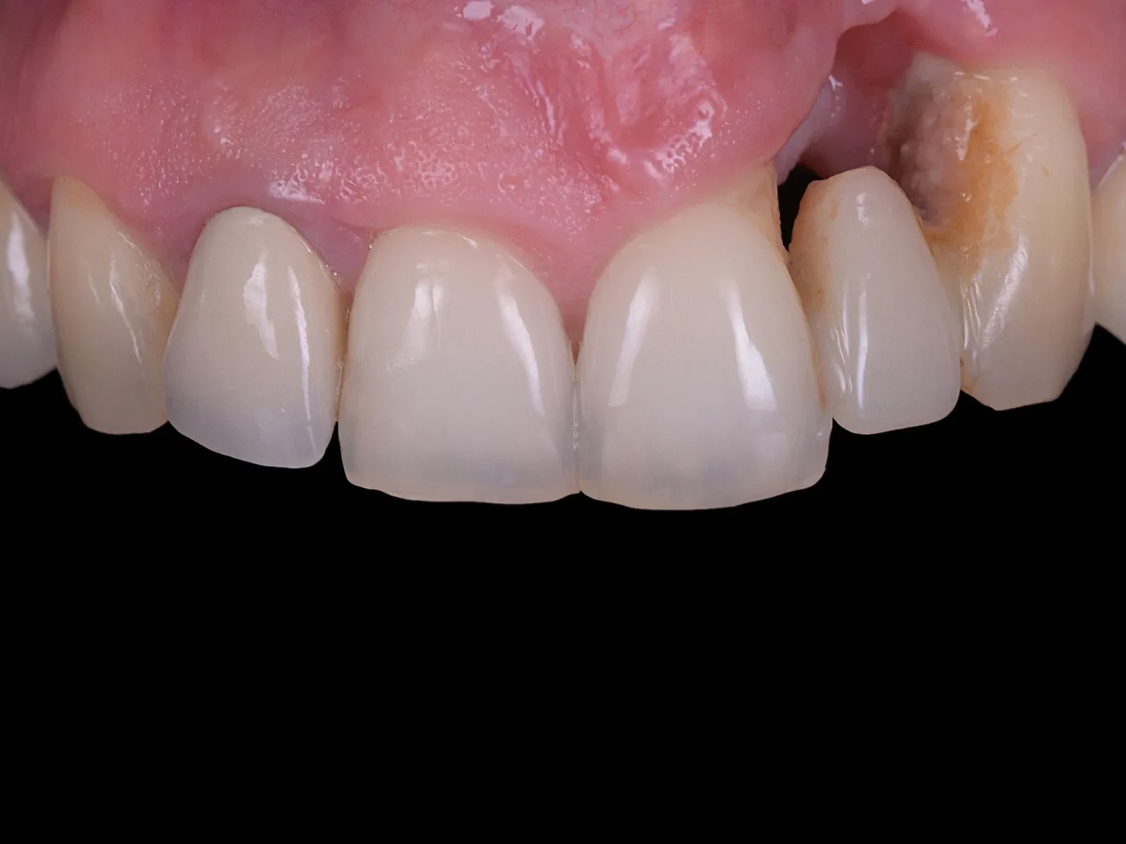 The gums around the front teeth before treatment, with recession