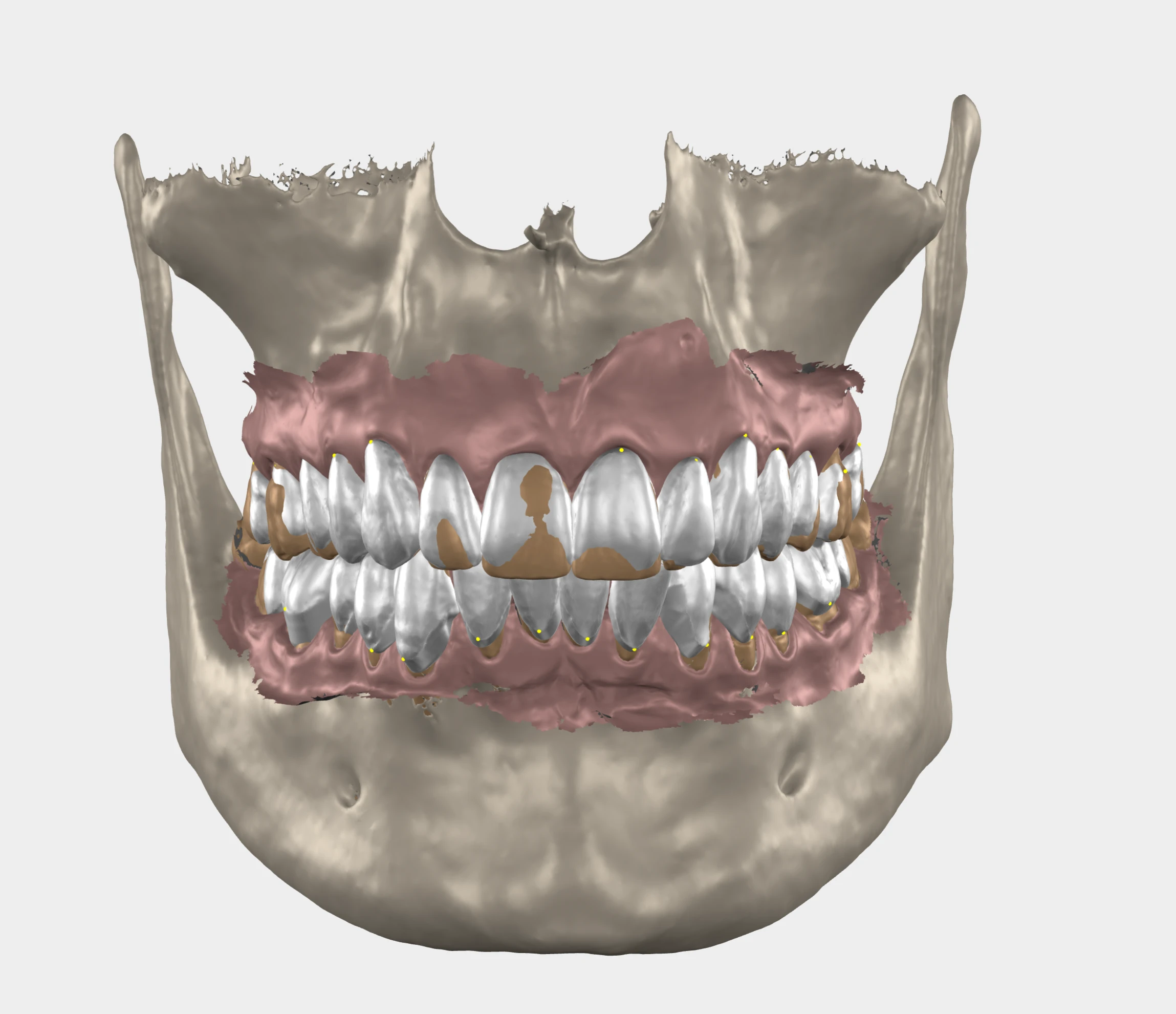 The planned teeth and gums designed in 3D over the scan of the jaws