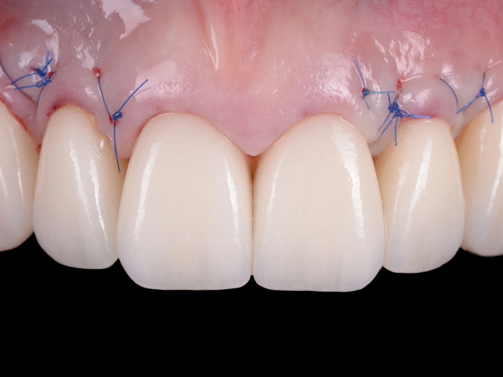 A gum graft in place around the front teeth, closed with fine stitches