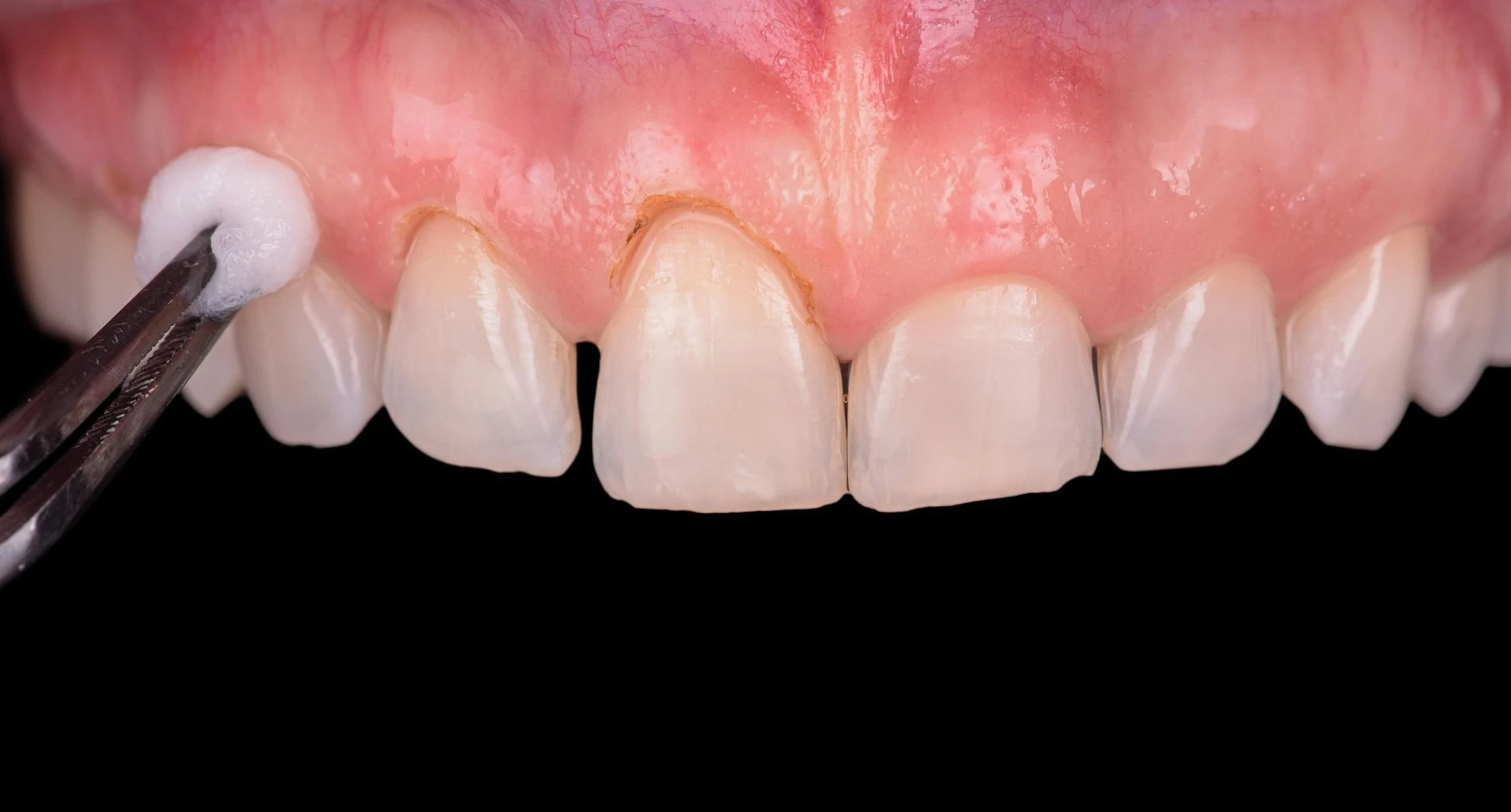The gum line right after reshaping, before the restorations
