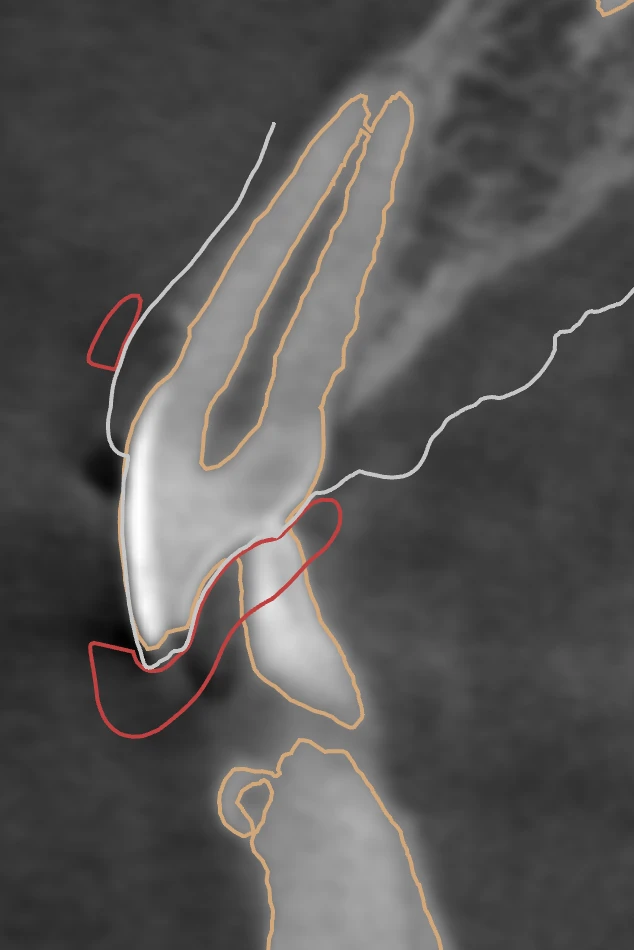 A 3D X-ray slice with the planned gum and bone levels marked