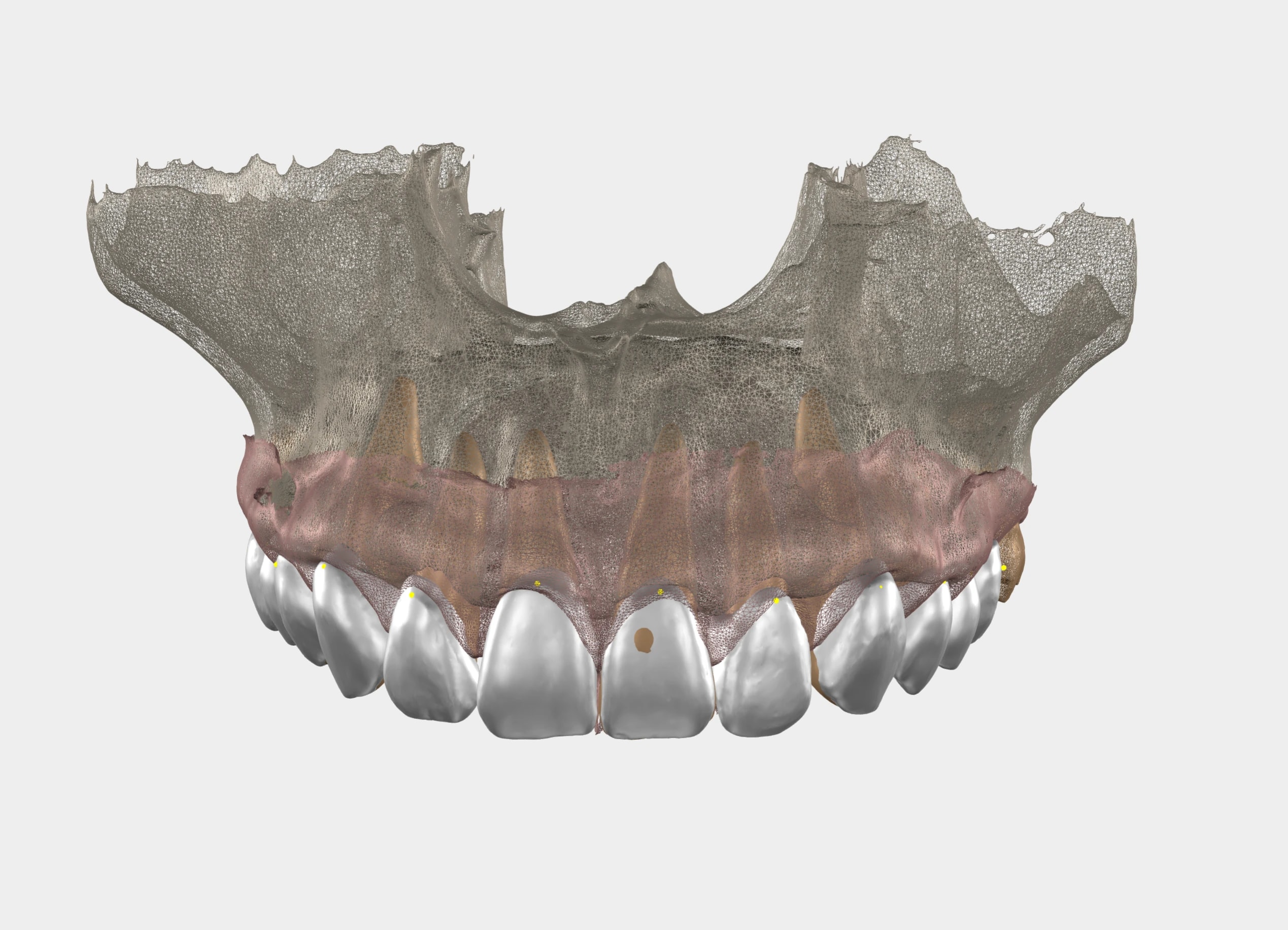 The final teeth designed in 3D over the scan of the jaw