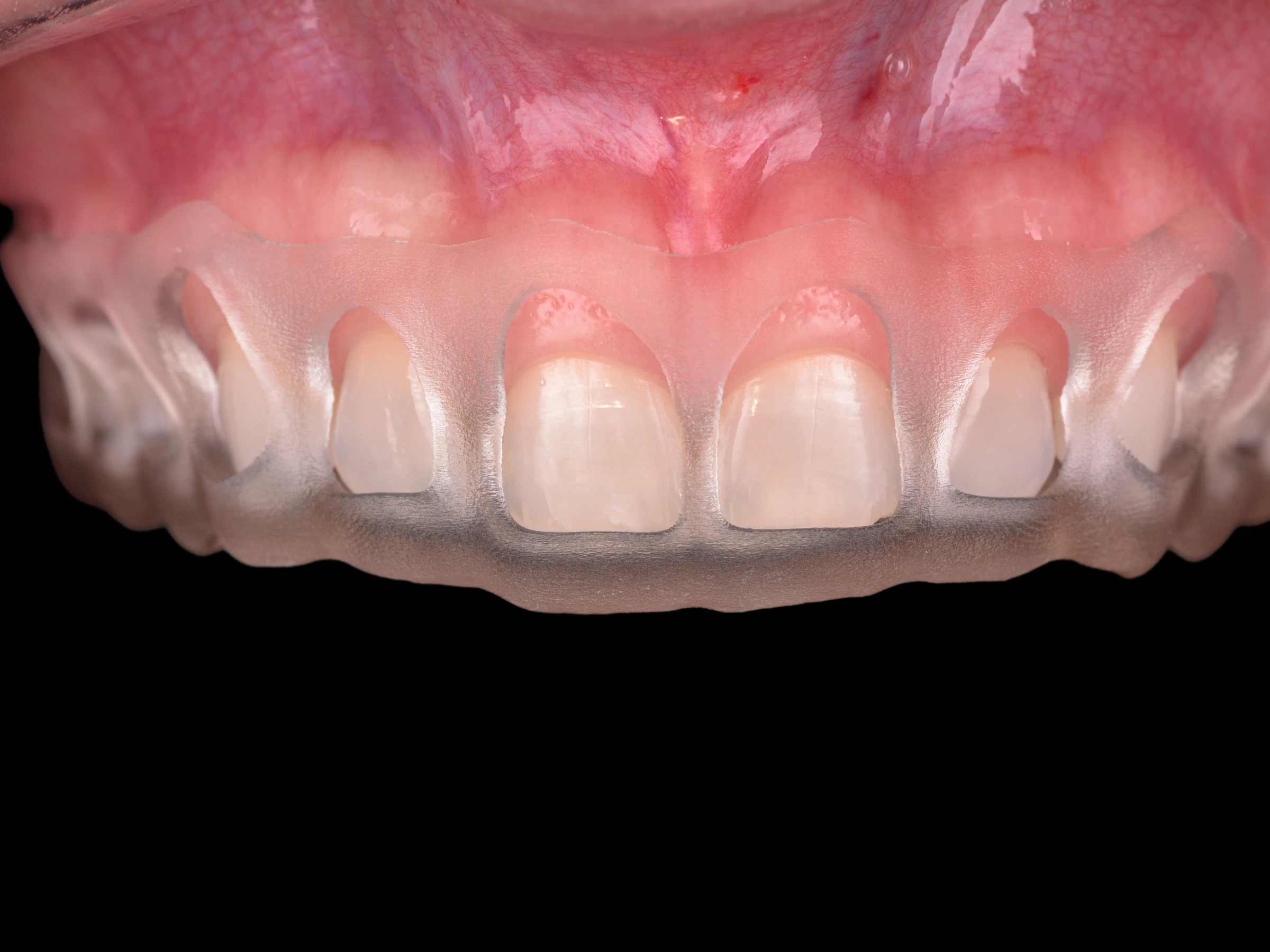 The surgical guide in place, marking the new gum line