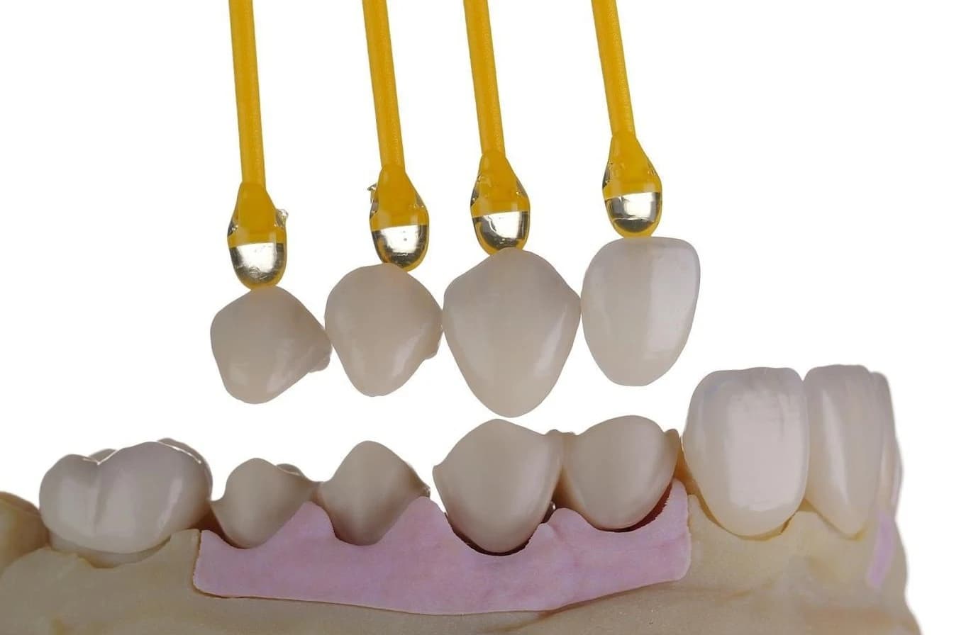 Milled ceramic restorations being placed on the lab model