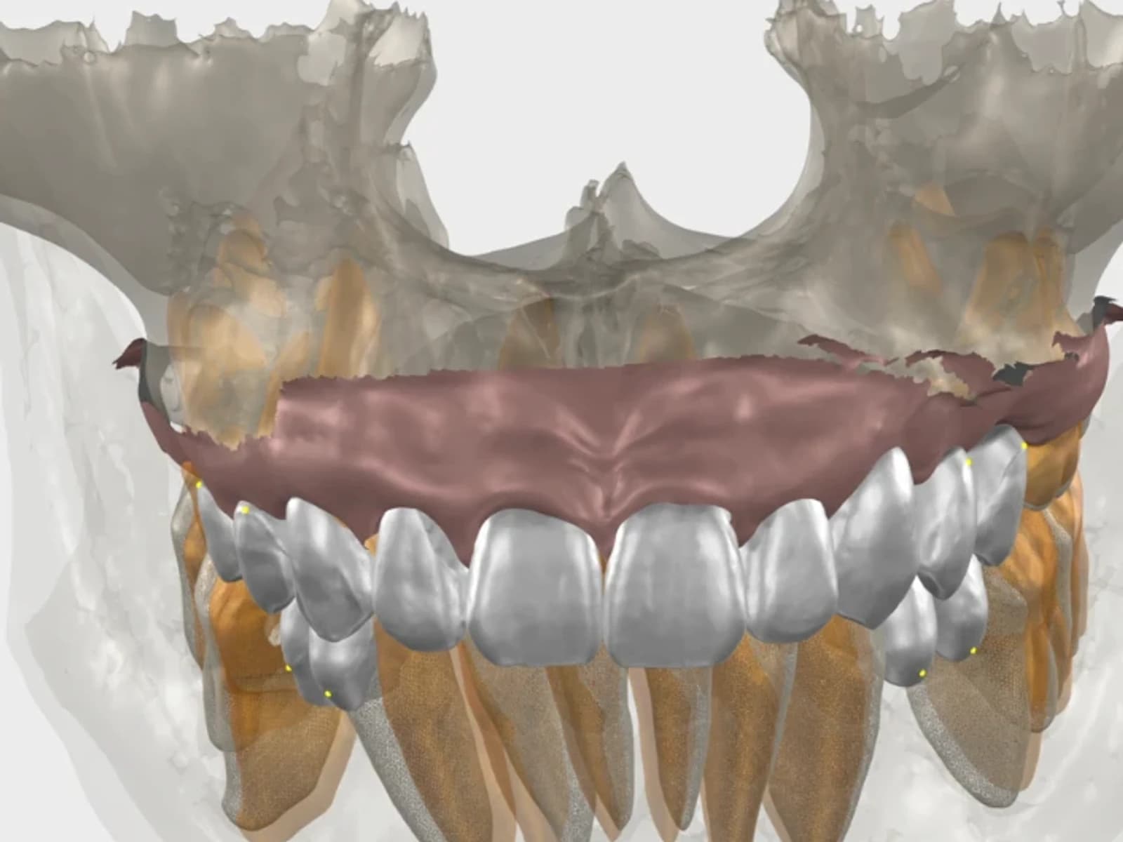 The planned teeth designed in 3D inside the scan of the jaws