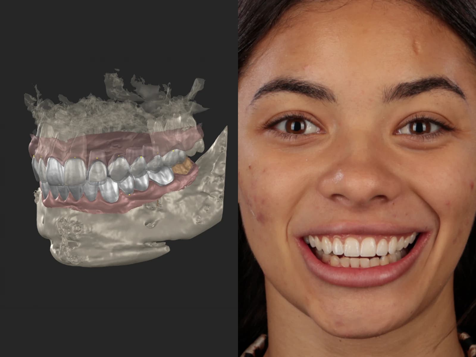 The planned teeth in 3D next to the patient’s smile