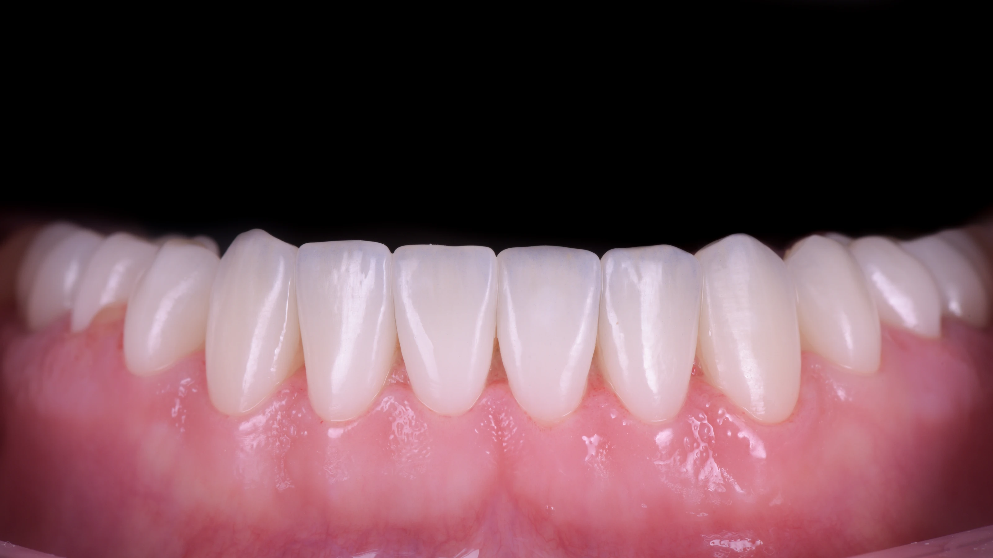 The same teeth with the finished veneers