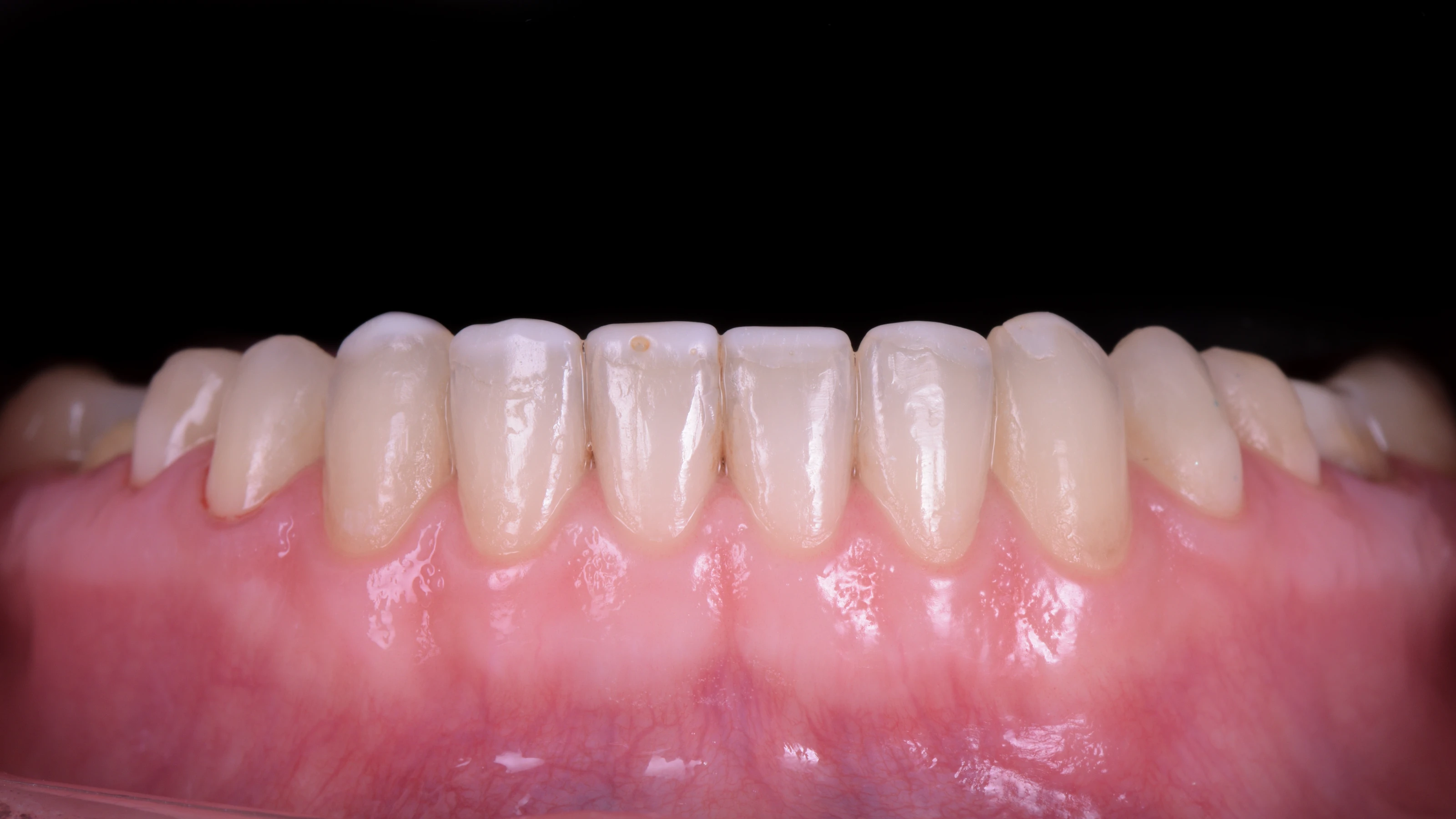 The lower front teeth before treatment, worn and uneven