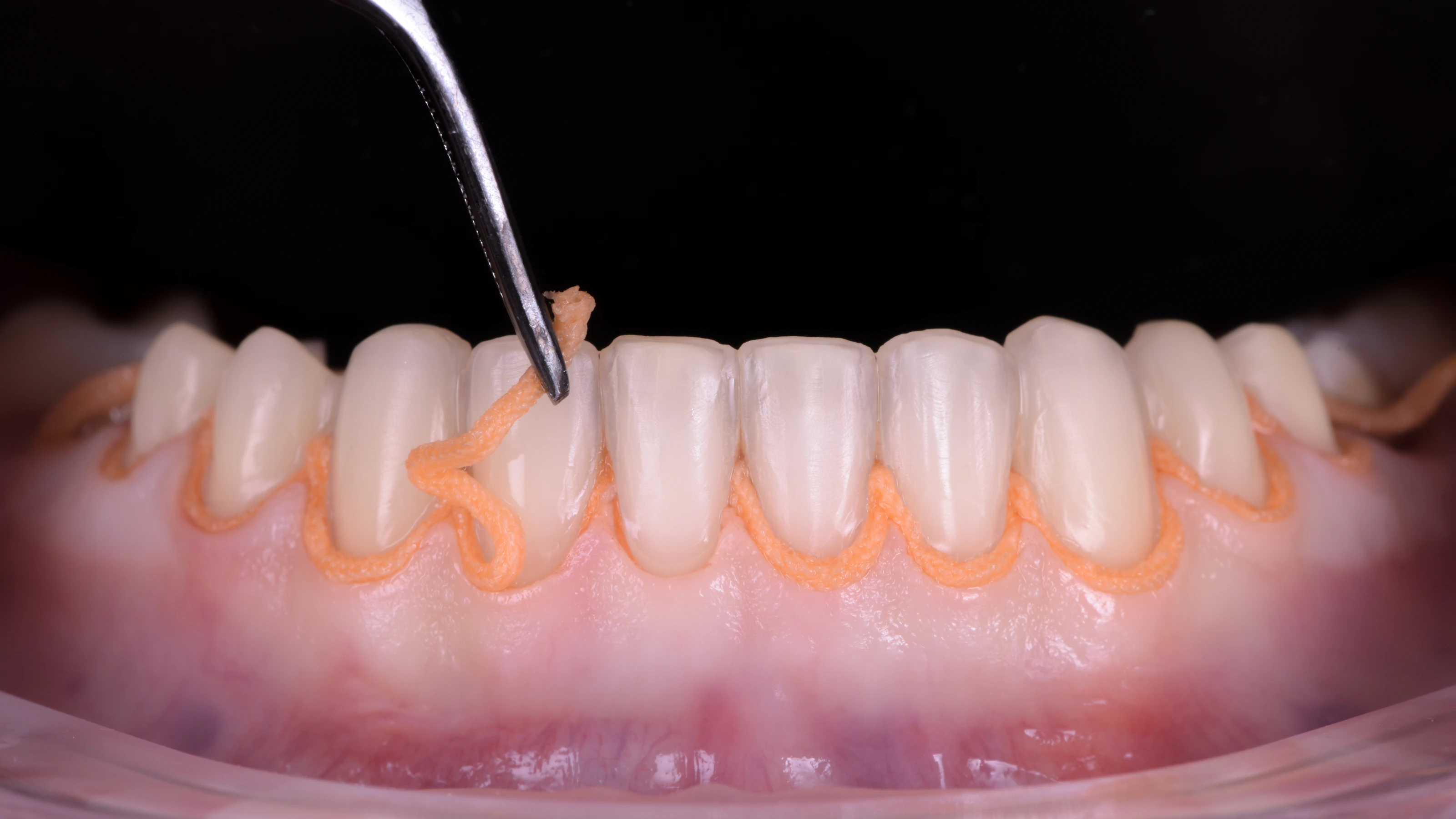 The prepared teeth with fine cords protecting the gum