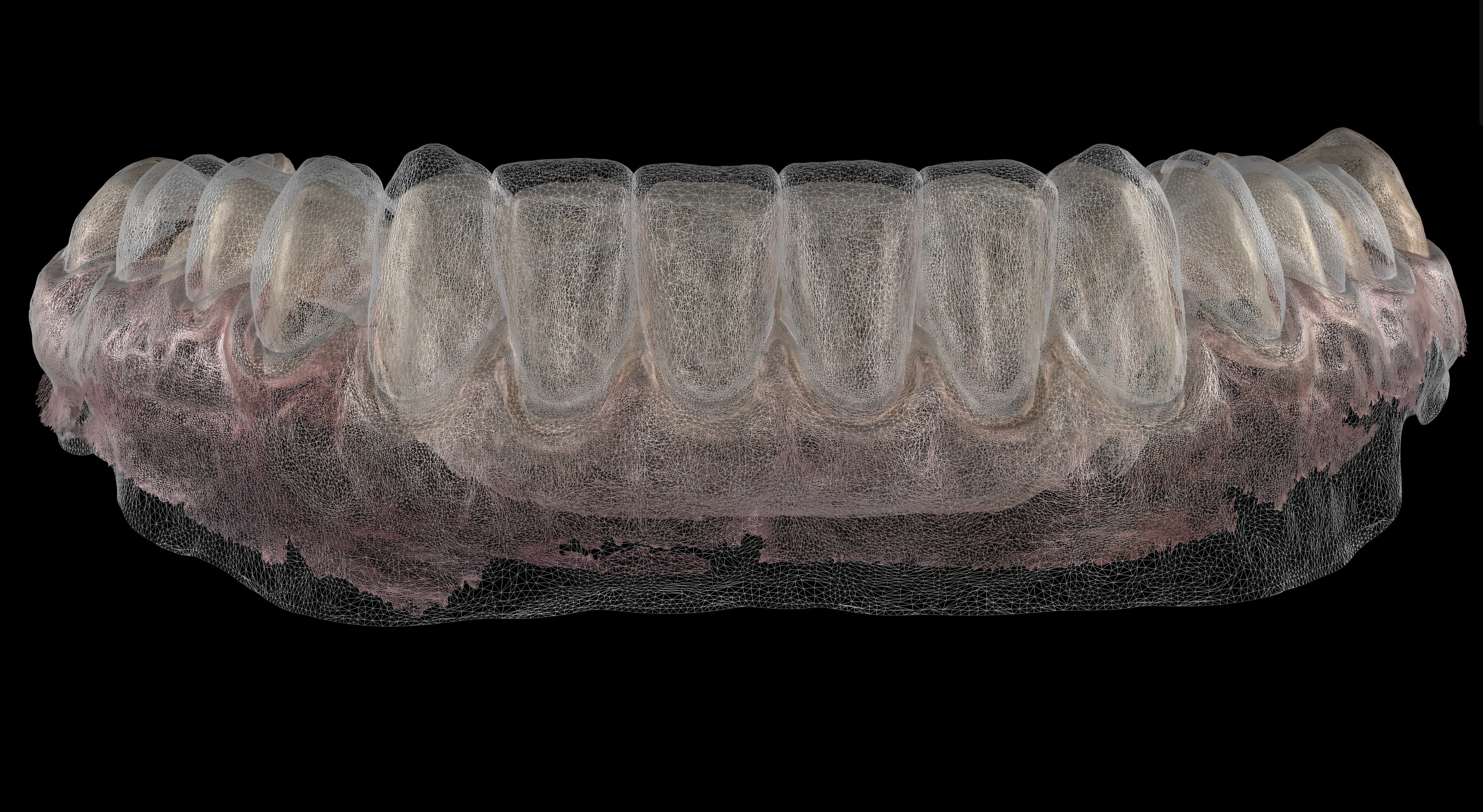 The digital design of the new teeth over the scan of the current ones