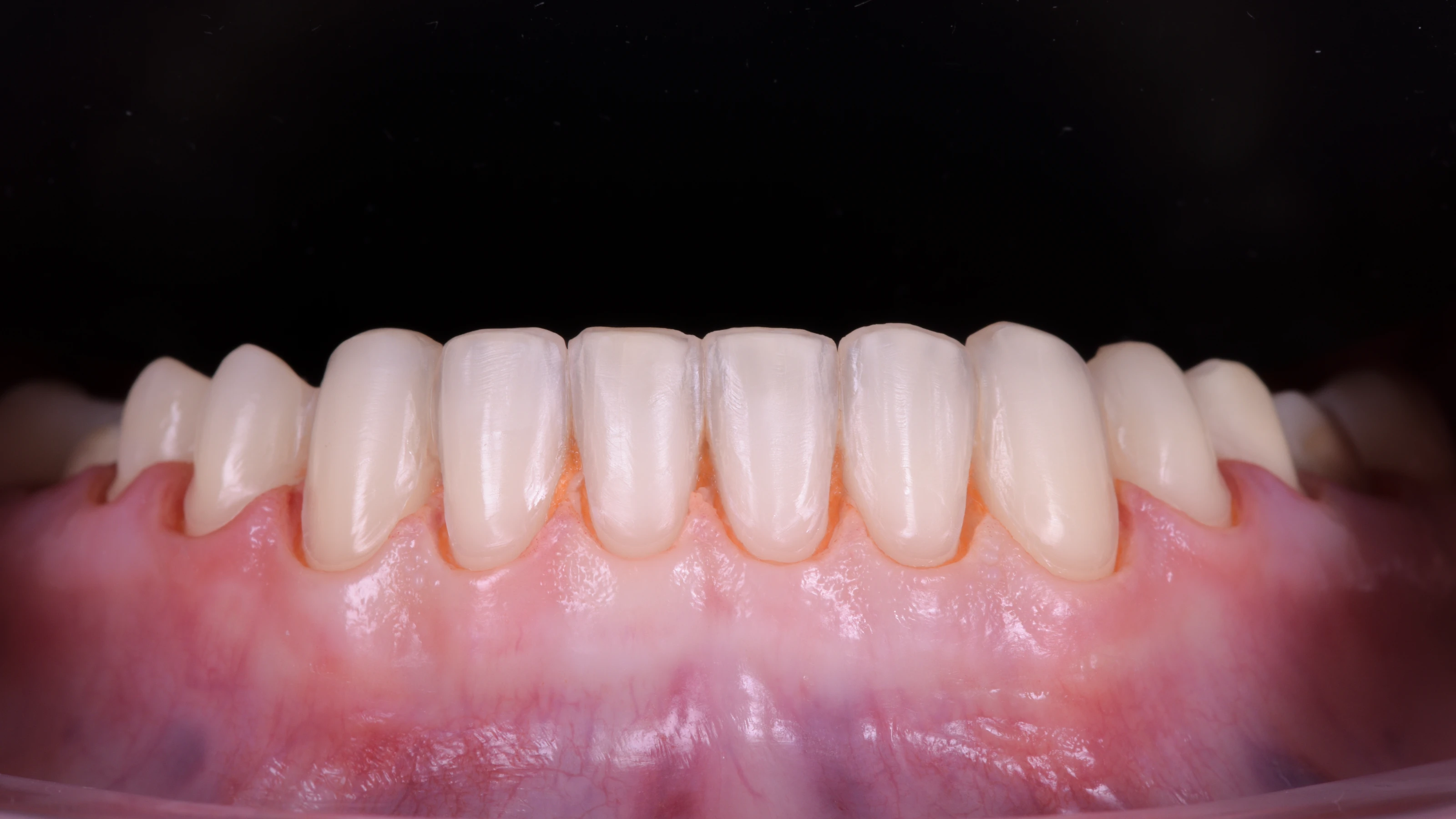 The teeth after preparation, checked against the design by scan
