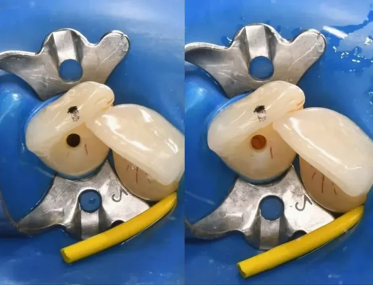 A front tooth isolated with a rubber dam, before and after the canal was opened