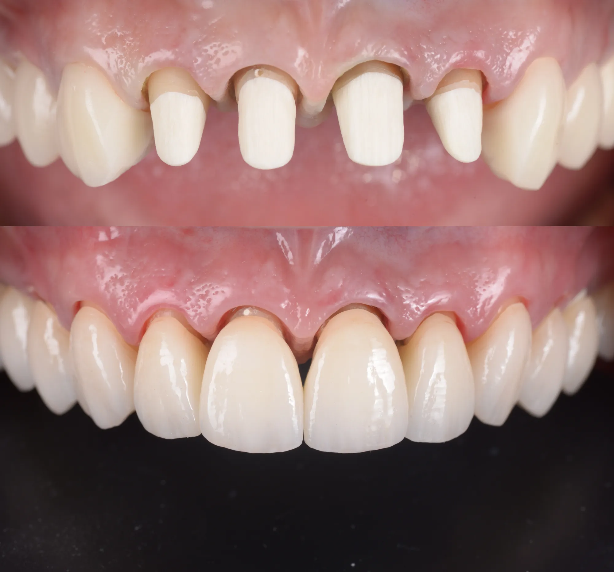 Prepared front teeth and the final crowns
