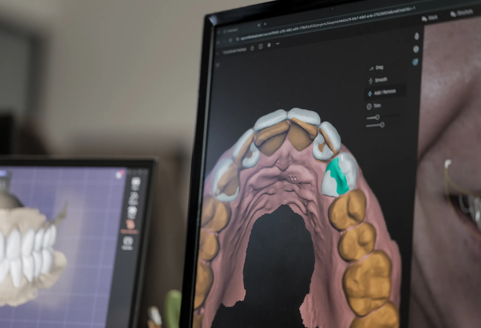 Digital design of an upper arch on screen