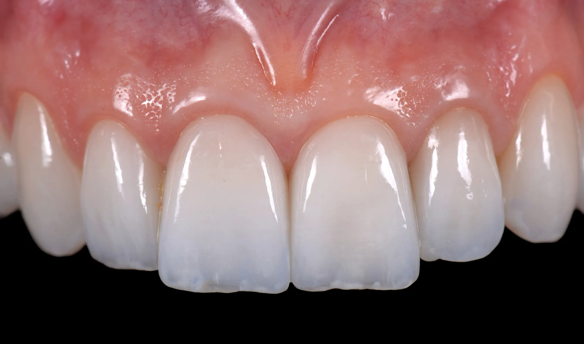 Finished ceramic restorations on the upper front teeth