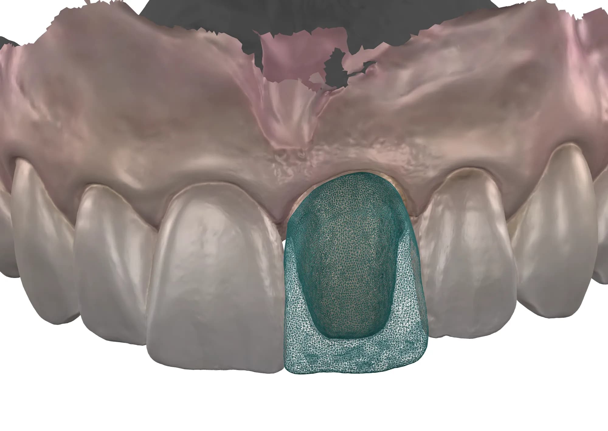 Digital design of a crown on a 3D scan