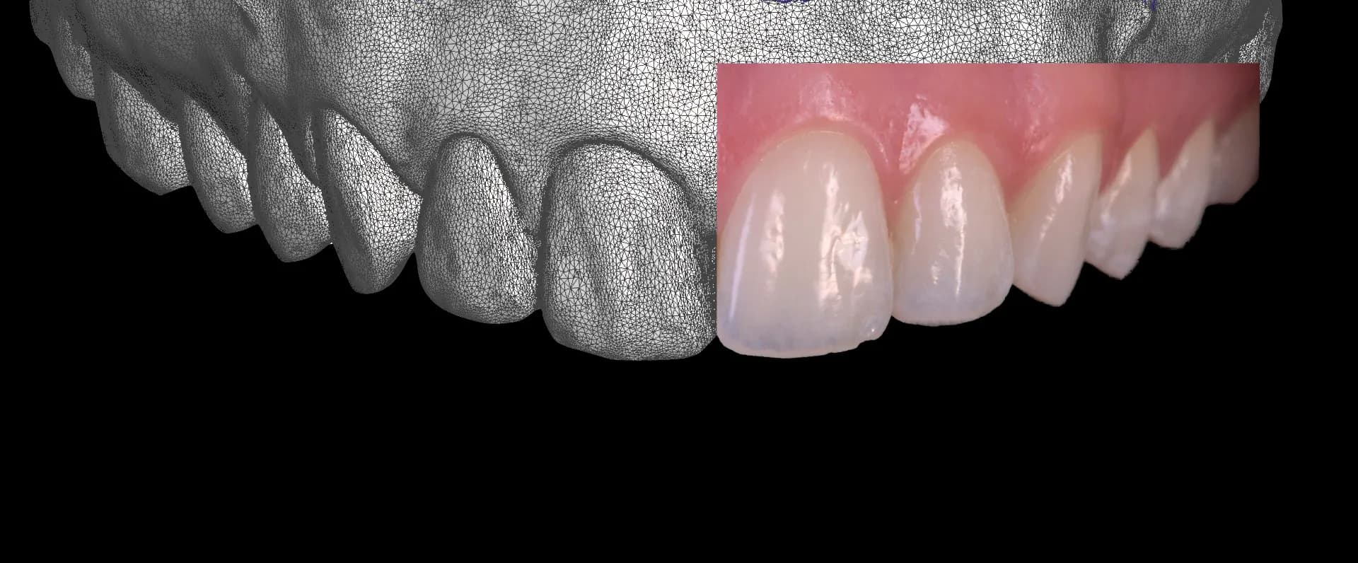Digital scan with the restoration design overlaid