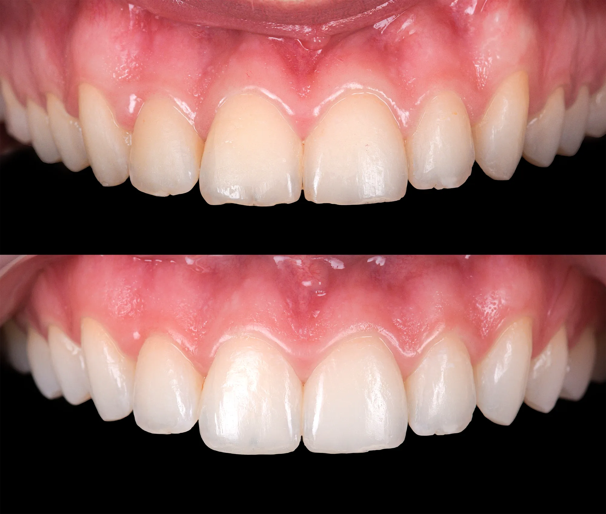 Front teeth before and after whitening
