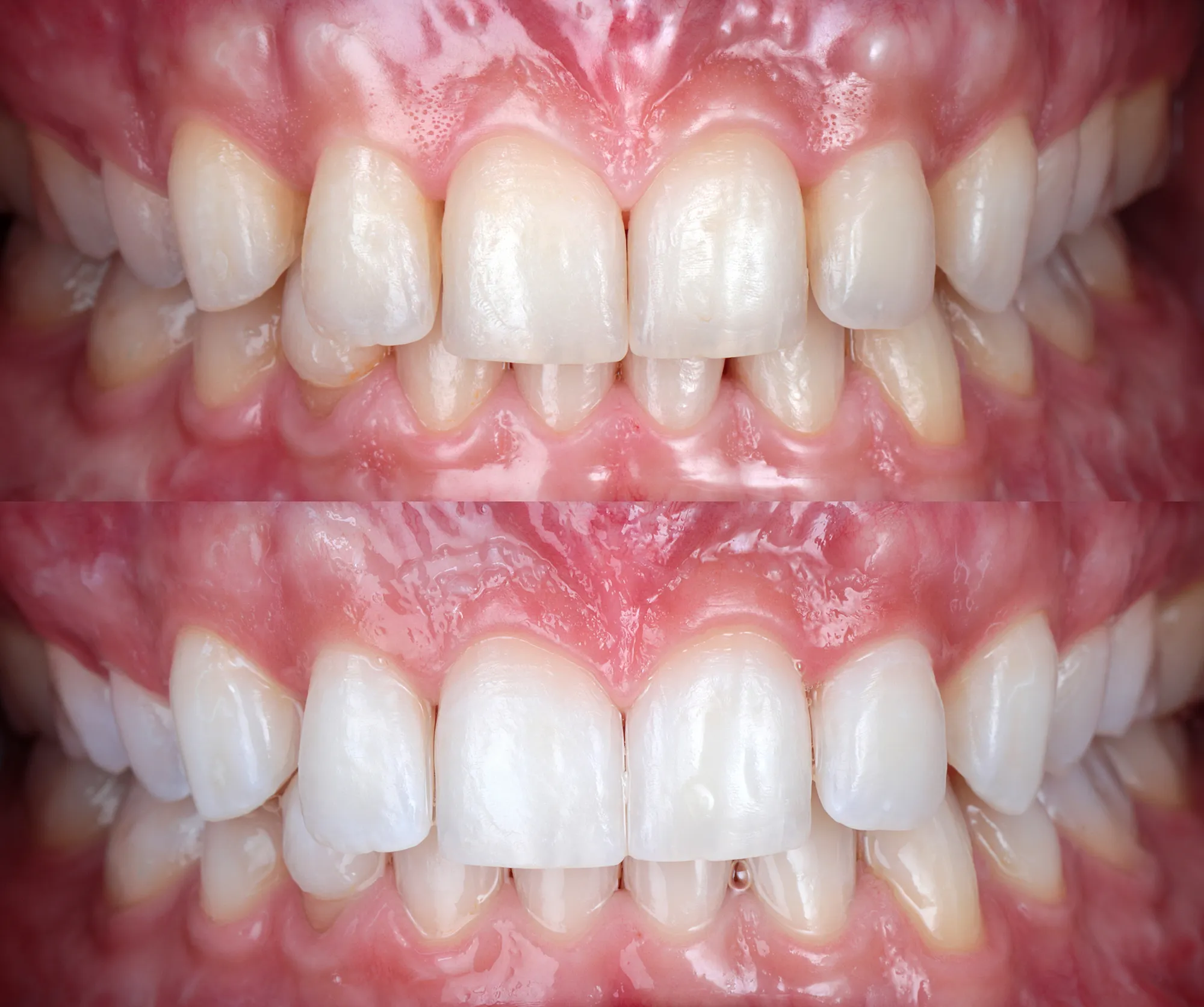 Teeth before and after whitening