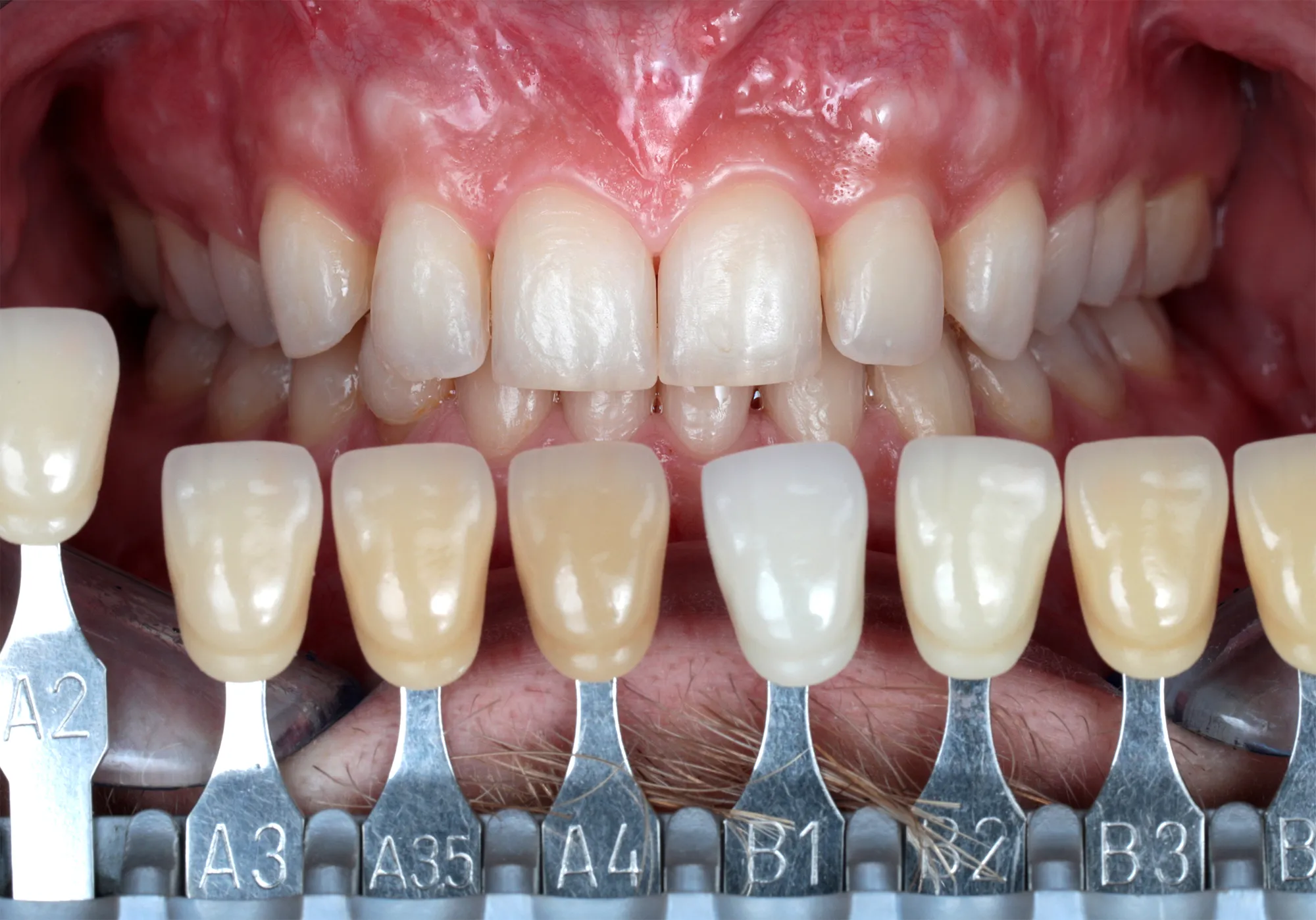 Shade tabs compared with the natural teeth at the check-up