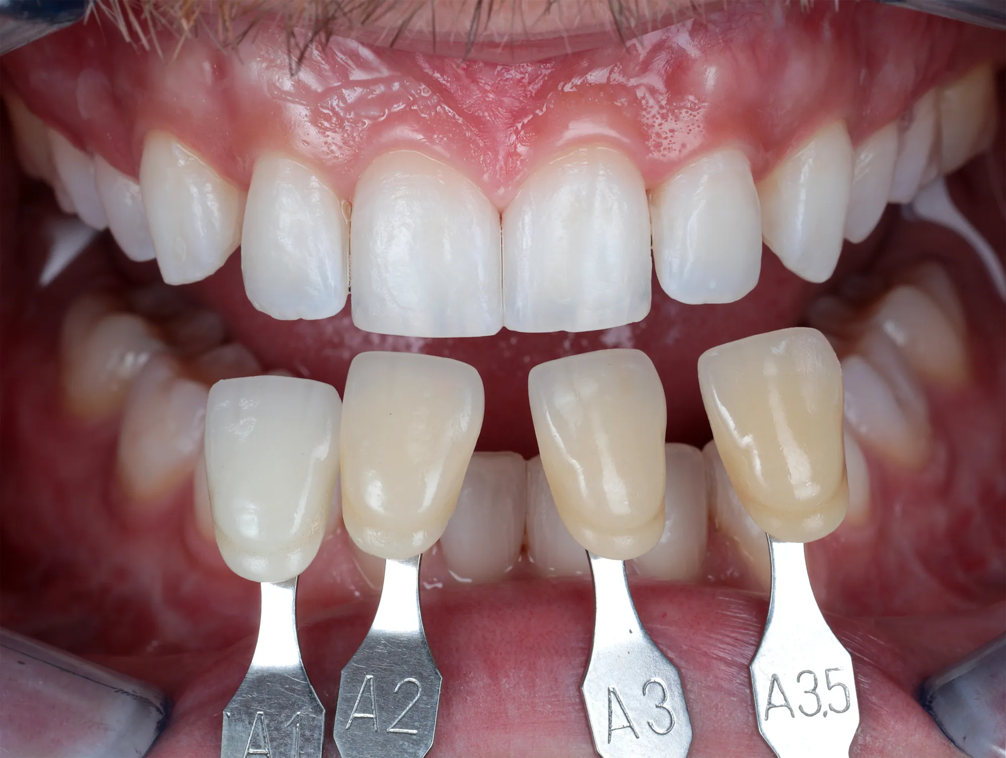 Shade tabs held below the teeth after whitening
