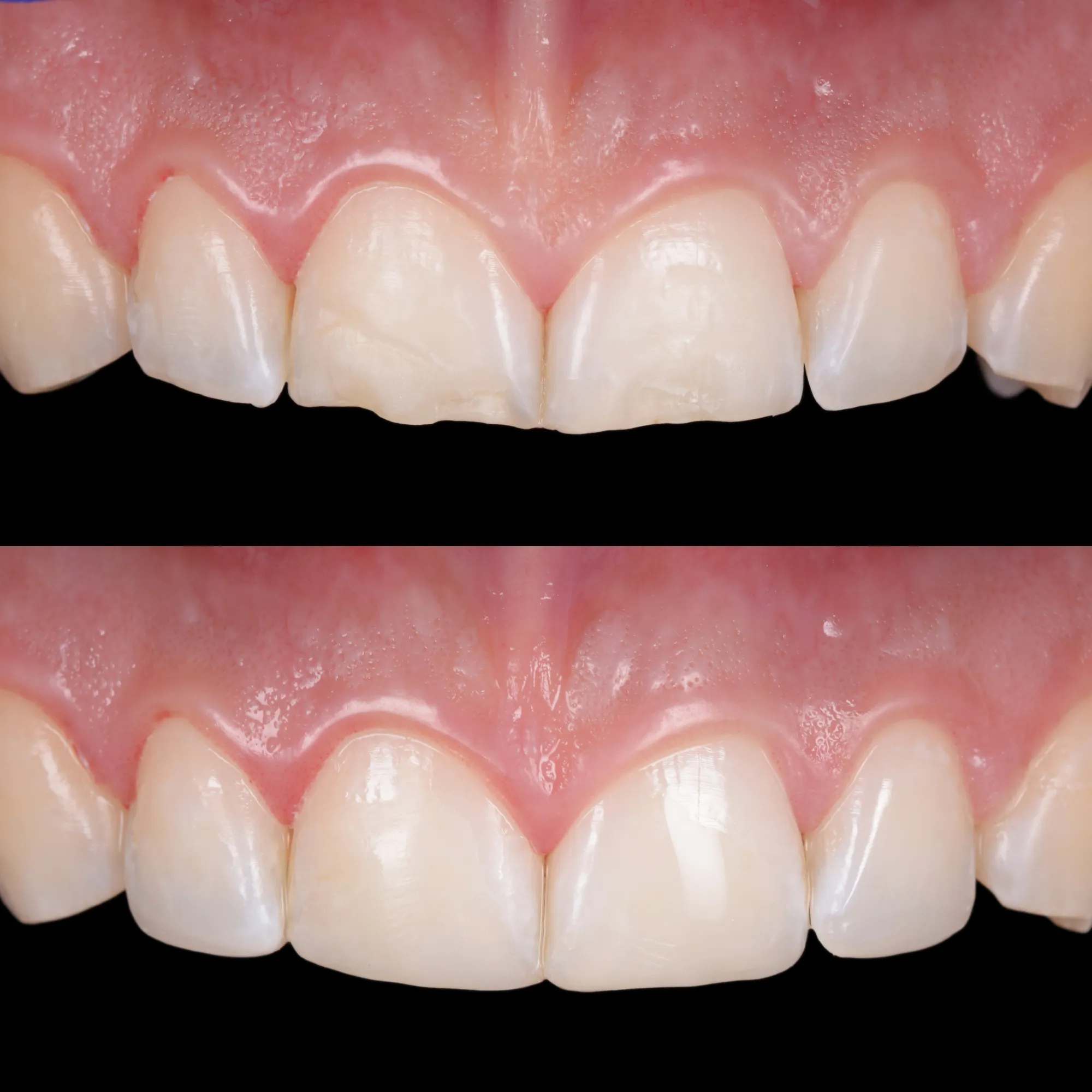 Chipped front teeth before and after composite repair