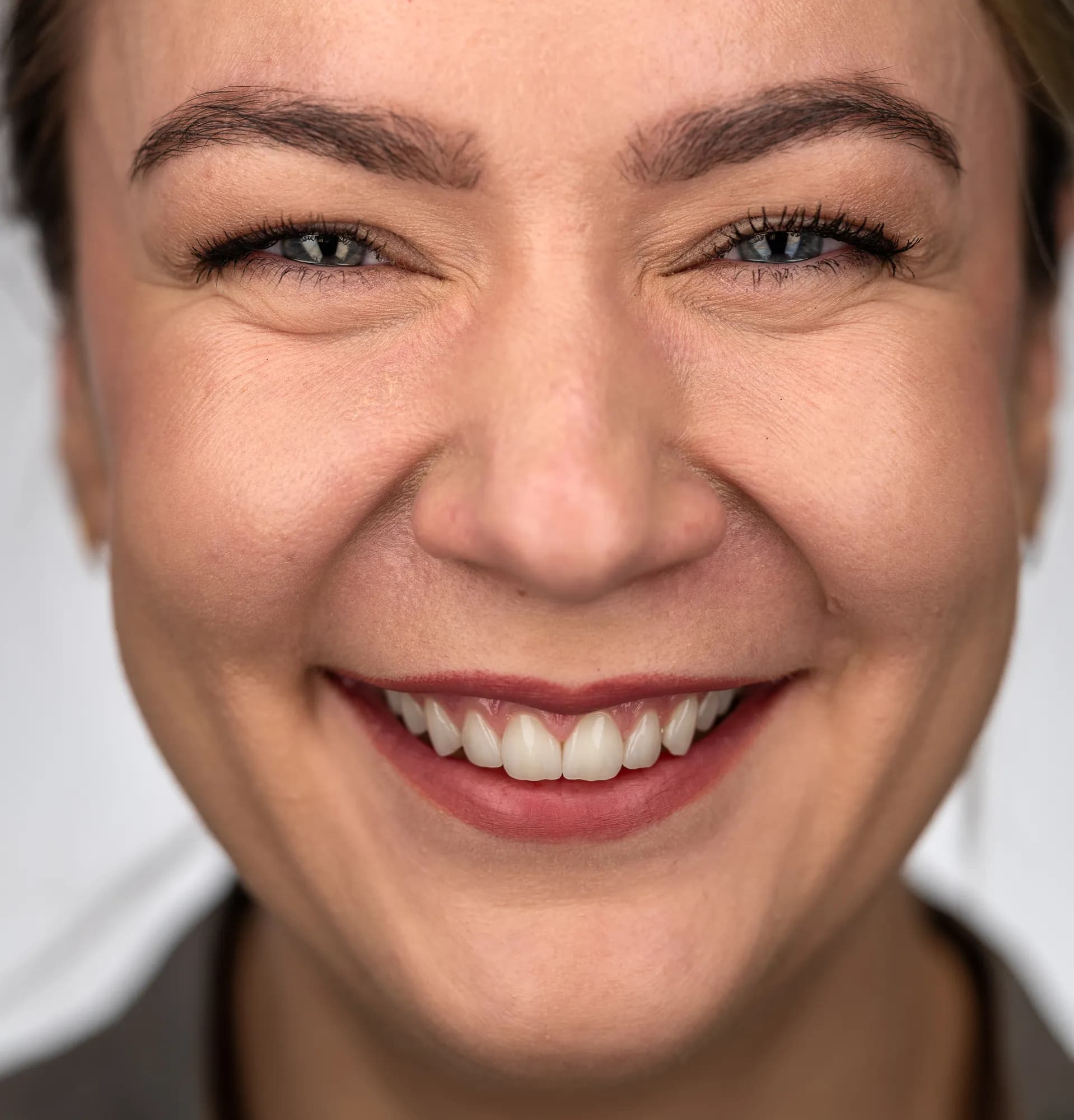 Gum contouring and veneers with a subtle design