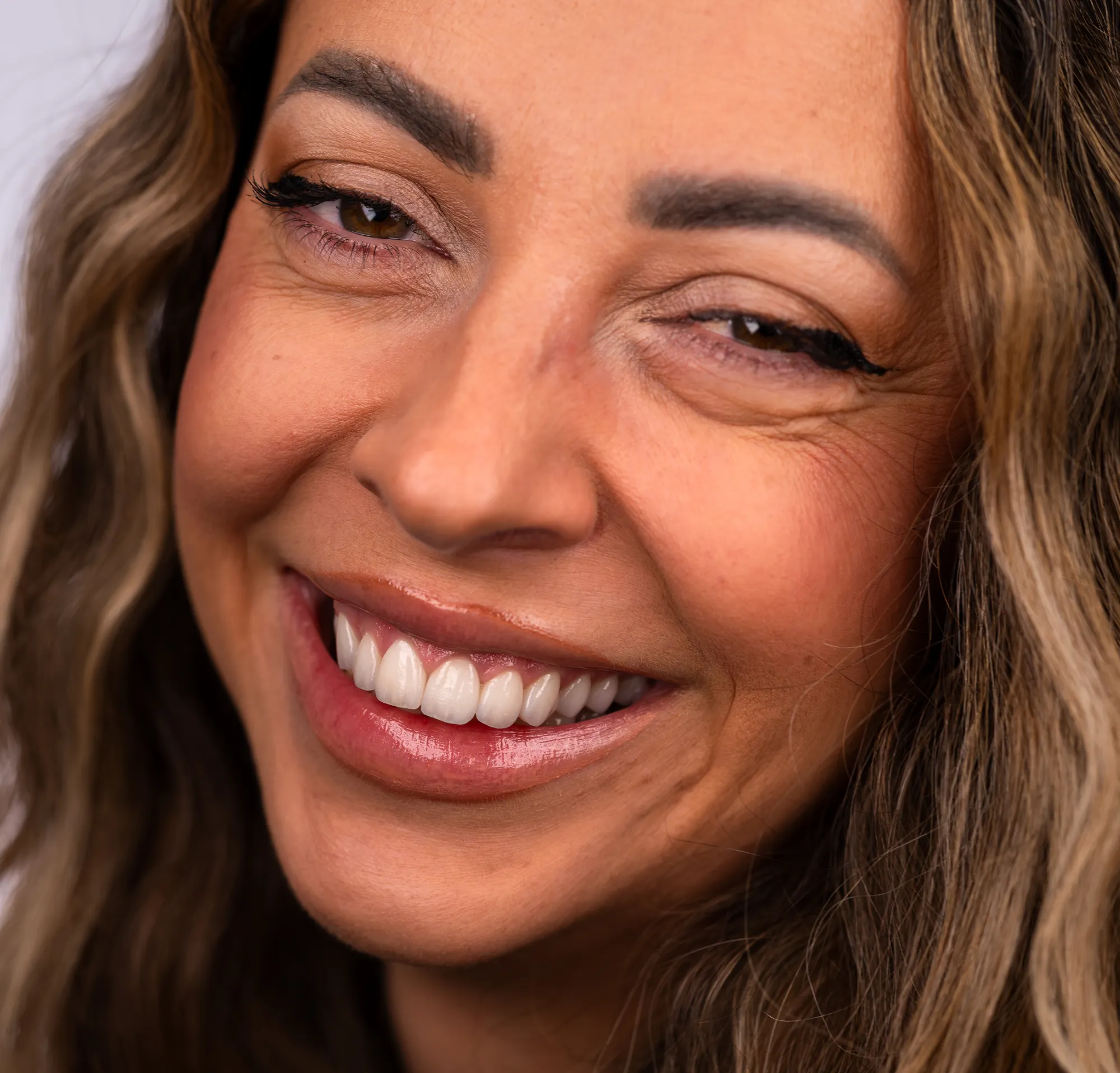 Gum contouring, veneers and a crown replacement