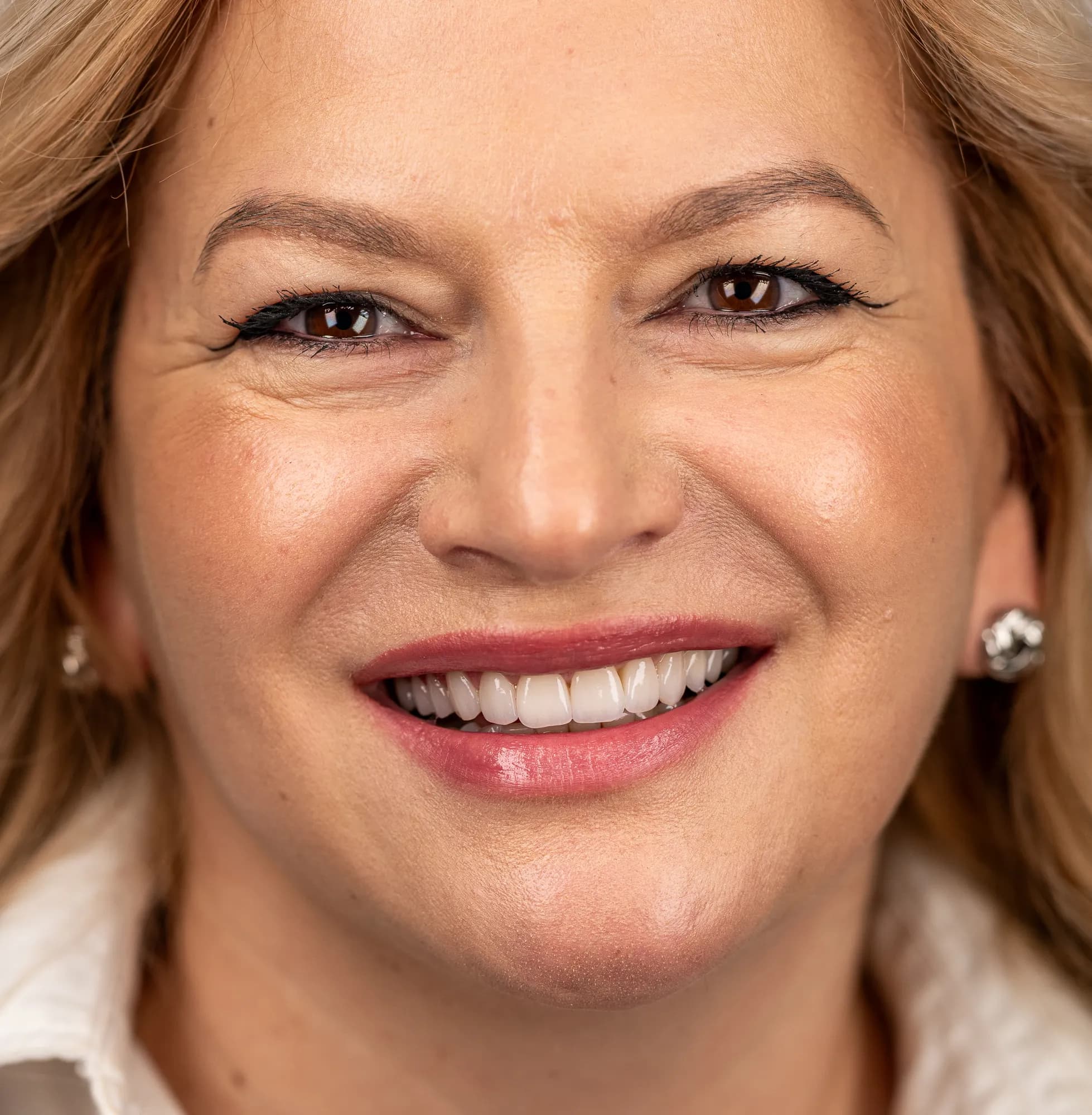 Implant, veneers and bite correction for a worn smile