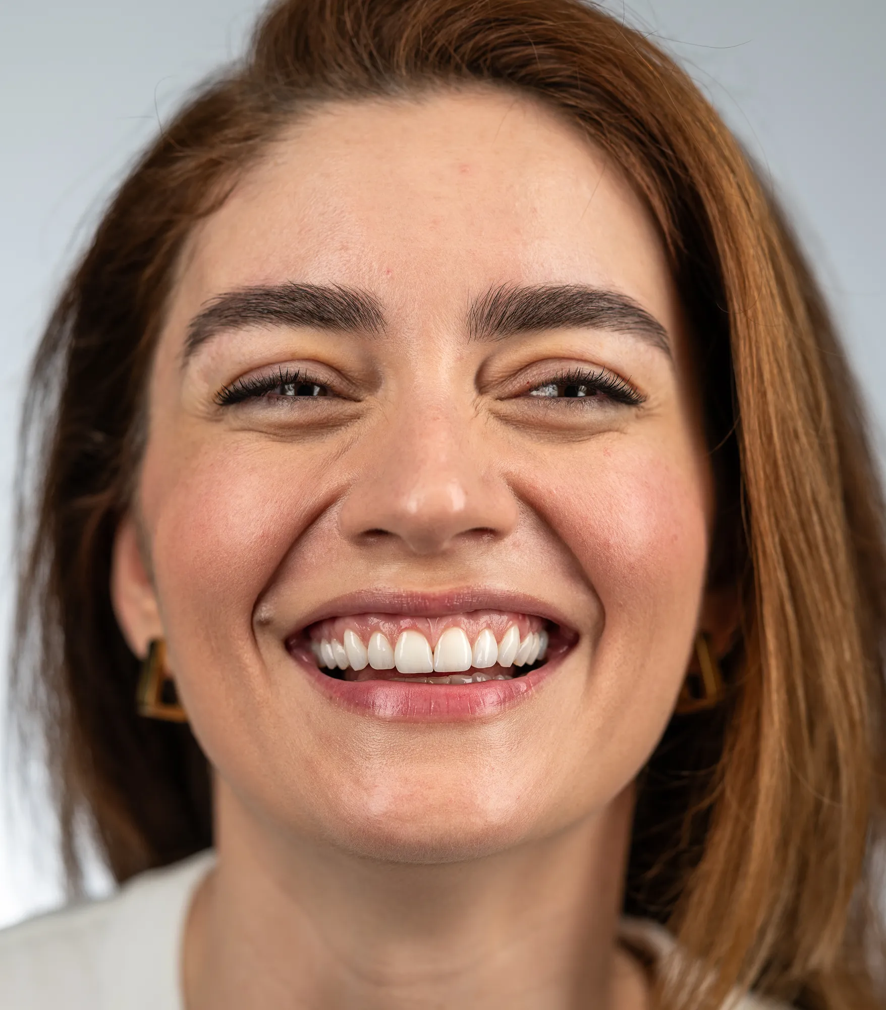Gum contouring and veneers with guided healing