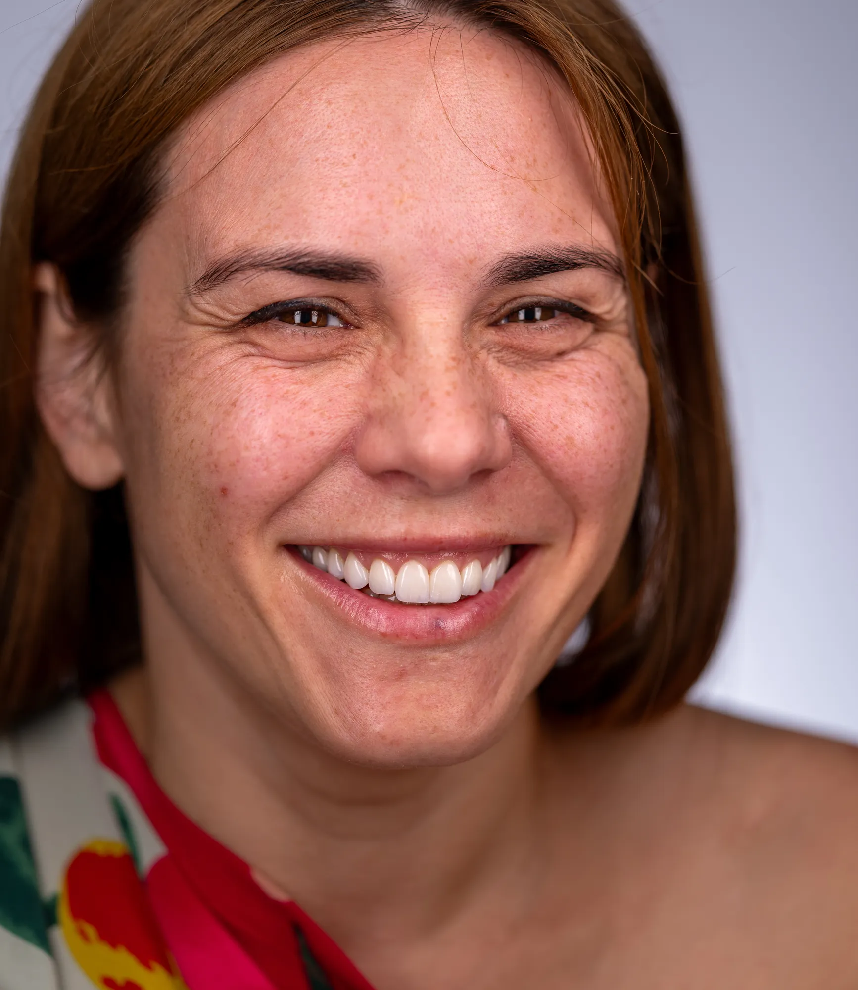 Missing lateral incisors: orthodontics, implants and veneers