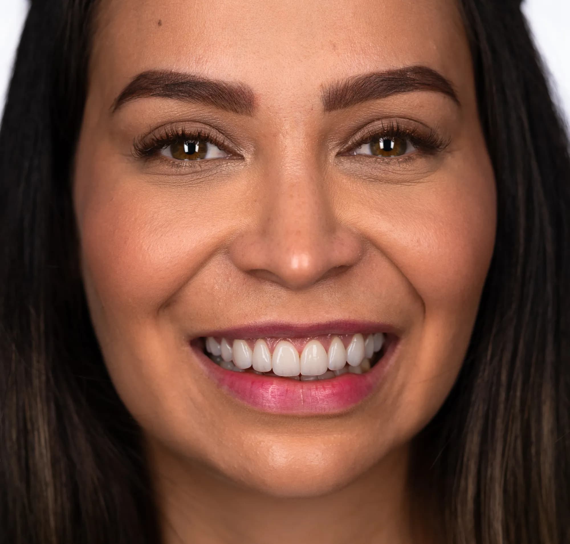 International team: jaw surgery, orthodontics and veneers