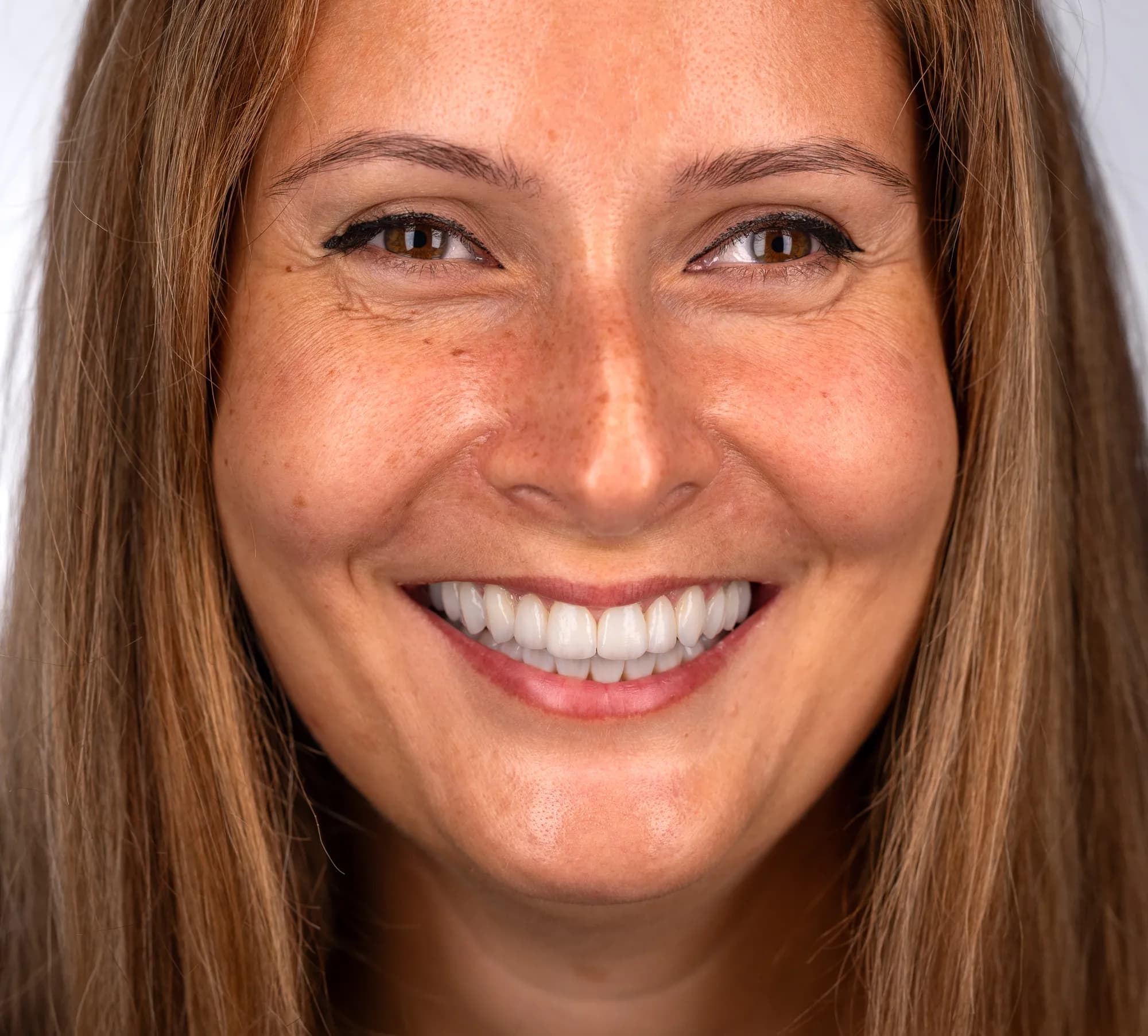 Full-arch implant bridge with a natural gum line