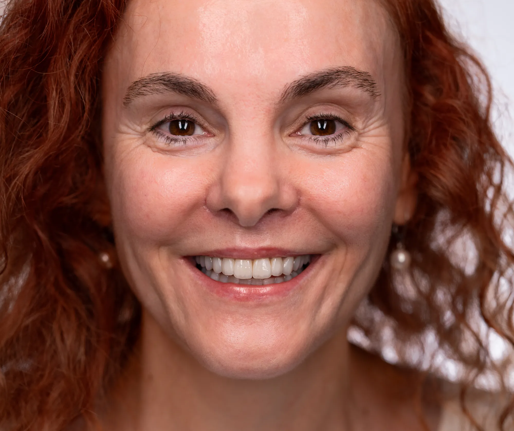 Full-mouth retreatment, bite correction and lip lift